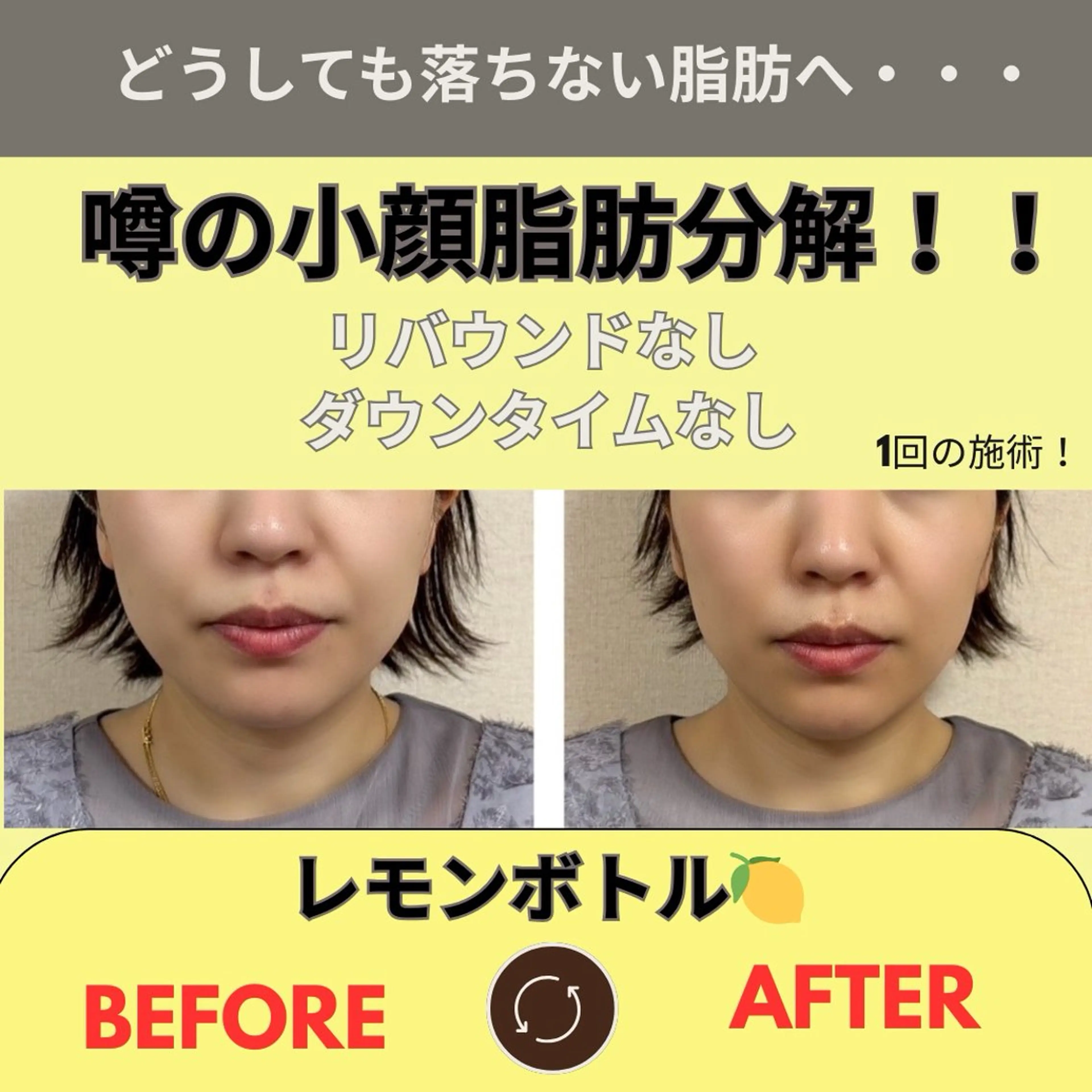 【結果重視】最新マシンで導入レモン　ボトル【横顔美人】キレイなフェイスラインへ！フェイスマスクつきの写真