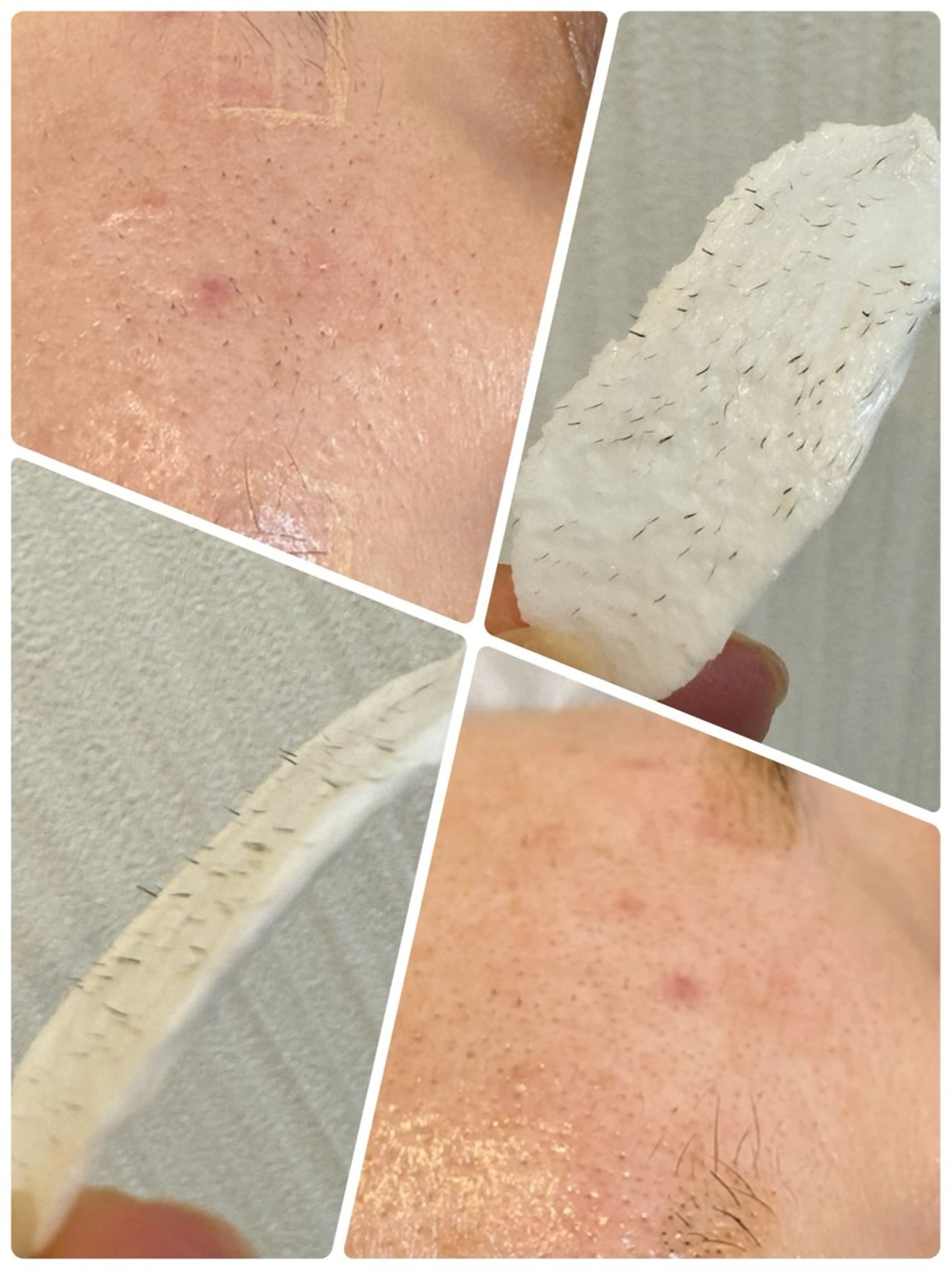 フェイシャルWAX脱毛の写真