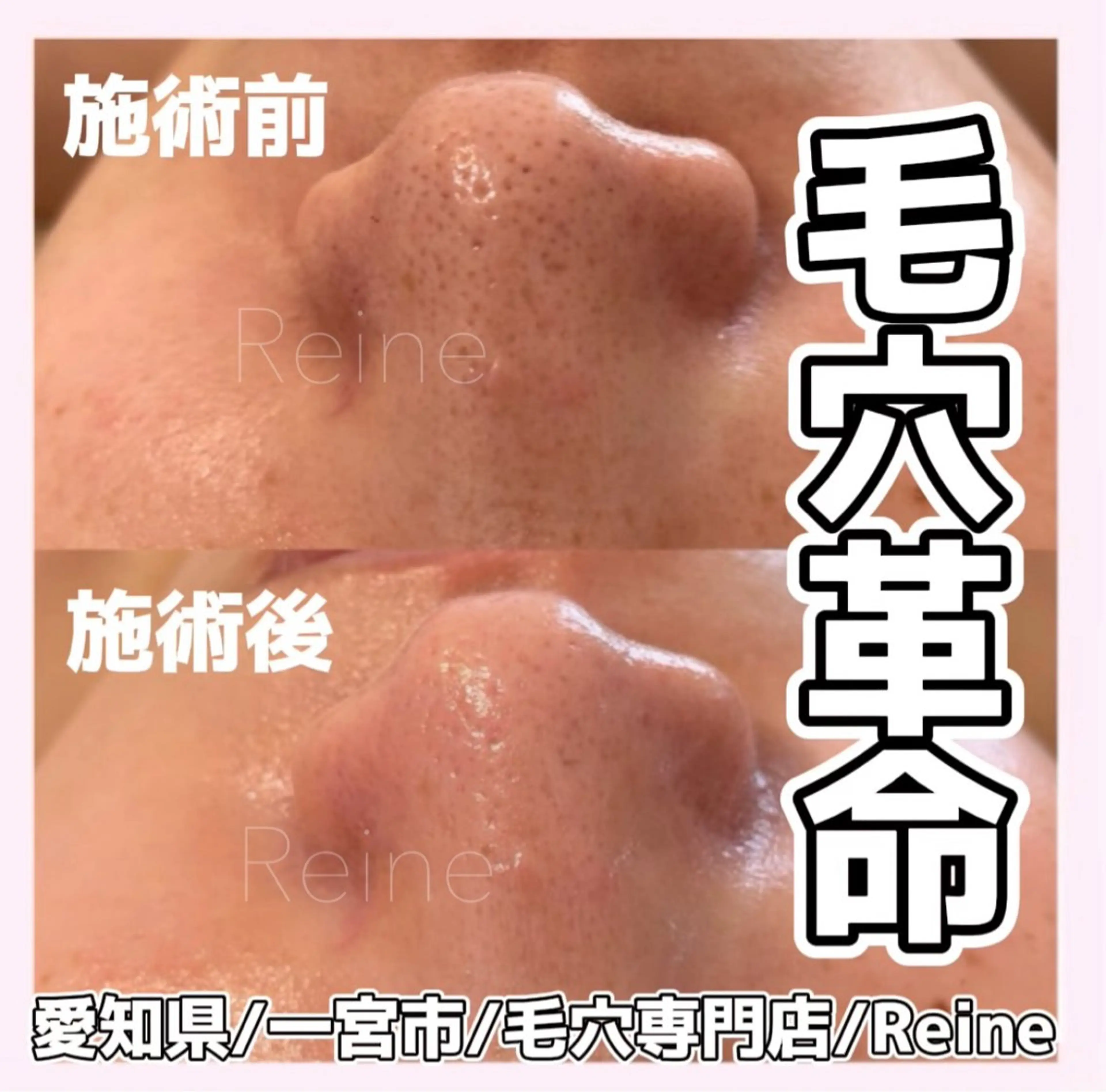 毛穴/シミ肝斑/脱毛 横山梨里のエステ・リラクイメージ