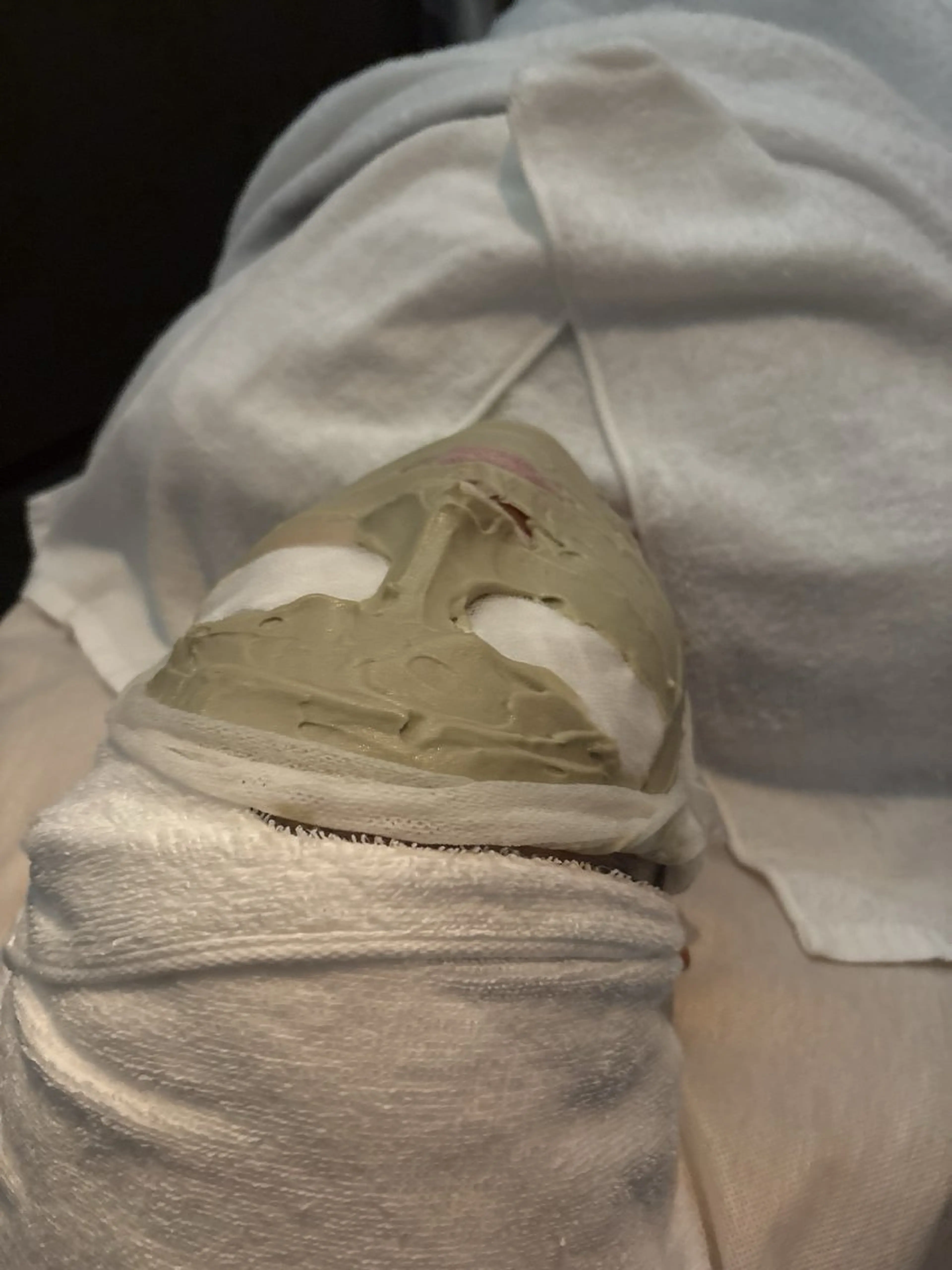 エステ ニキビ跡/毛穴/ 肌質改善/北村ももこのエステ・リラクイメージ