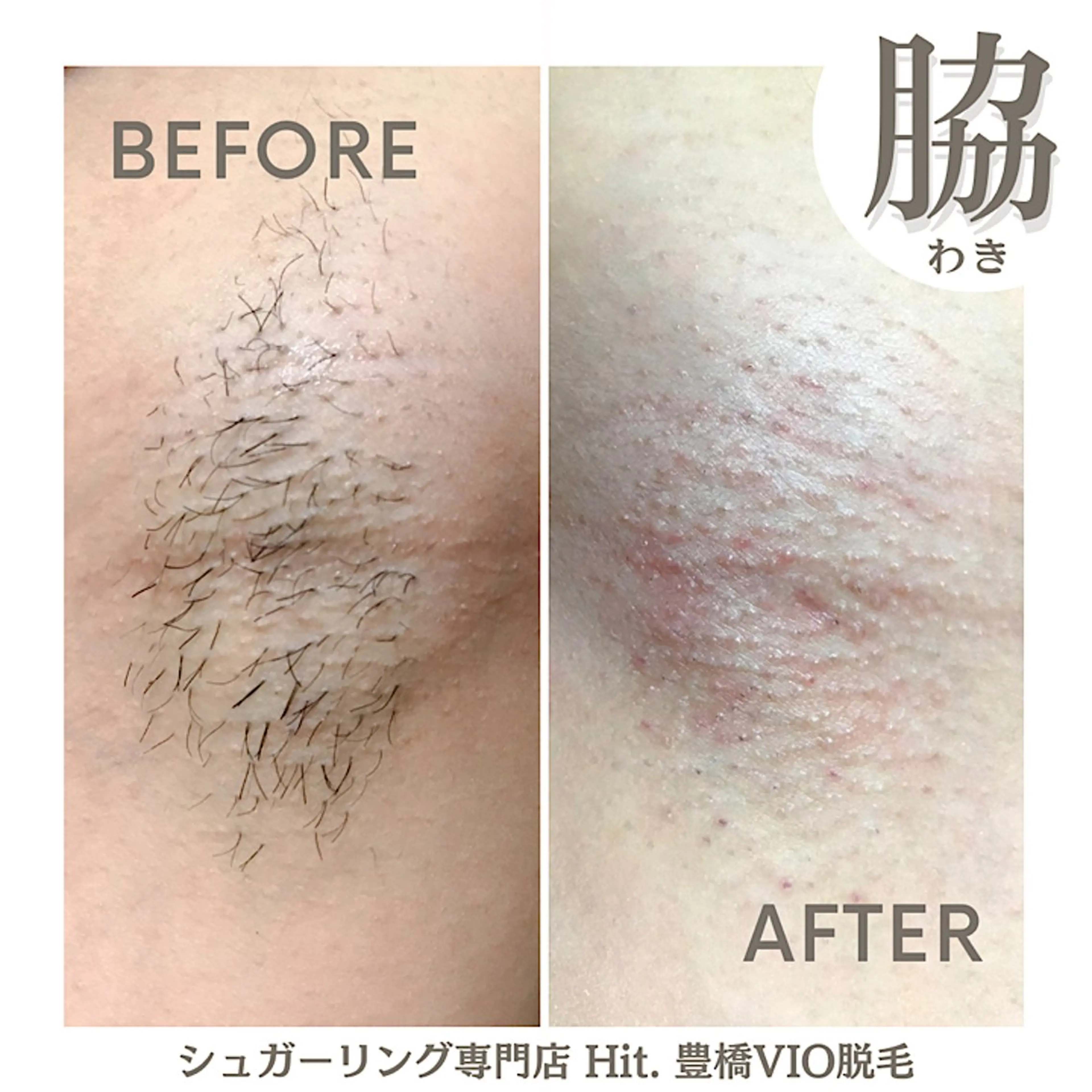 脱毛 Hitomi シュガーリング豊橋のその他イメージ