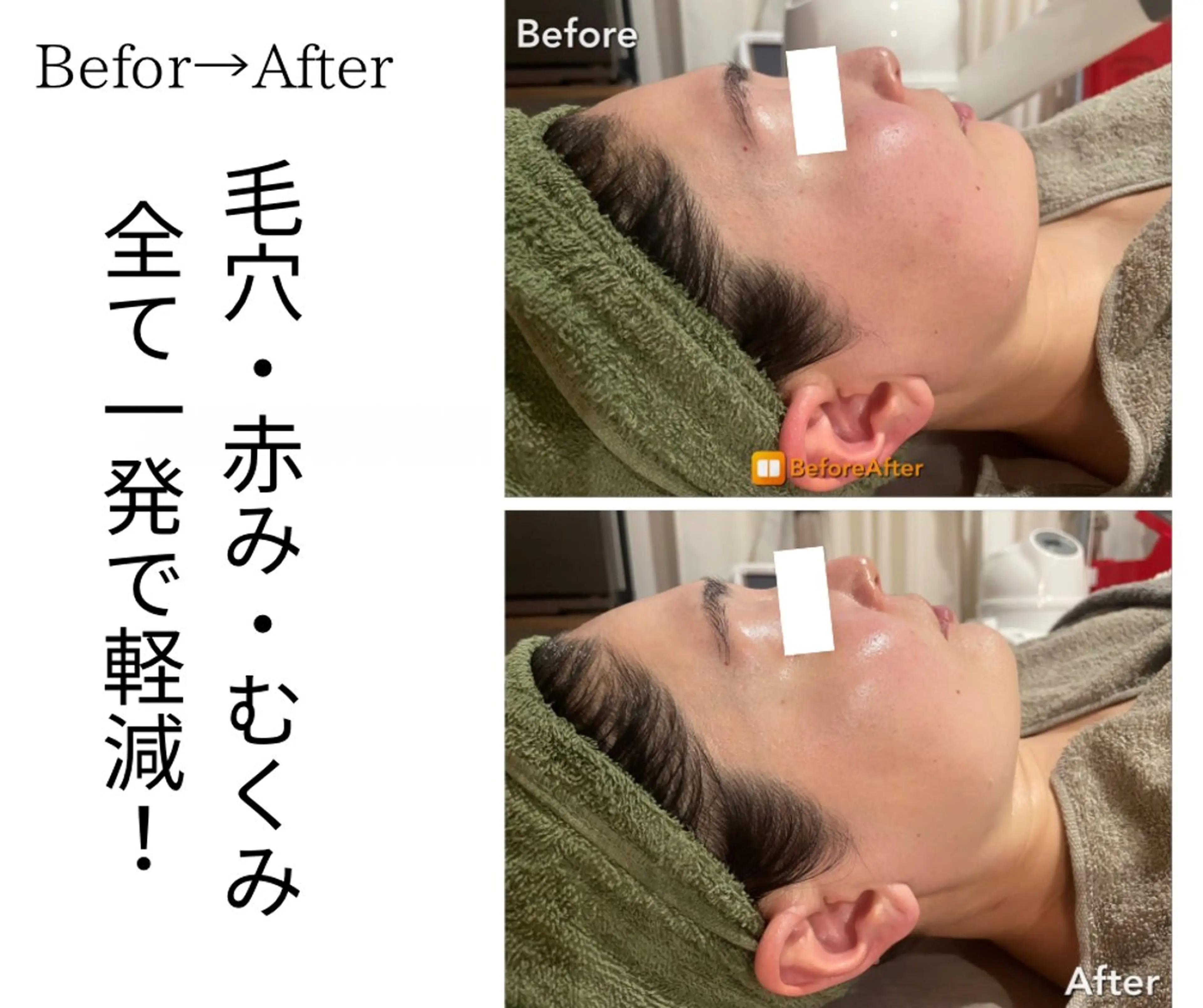 エステ Meupニキビ専門店 背中/ハーブ/肌管理のその他イメージ