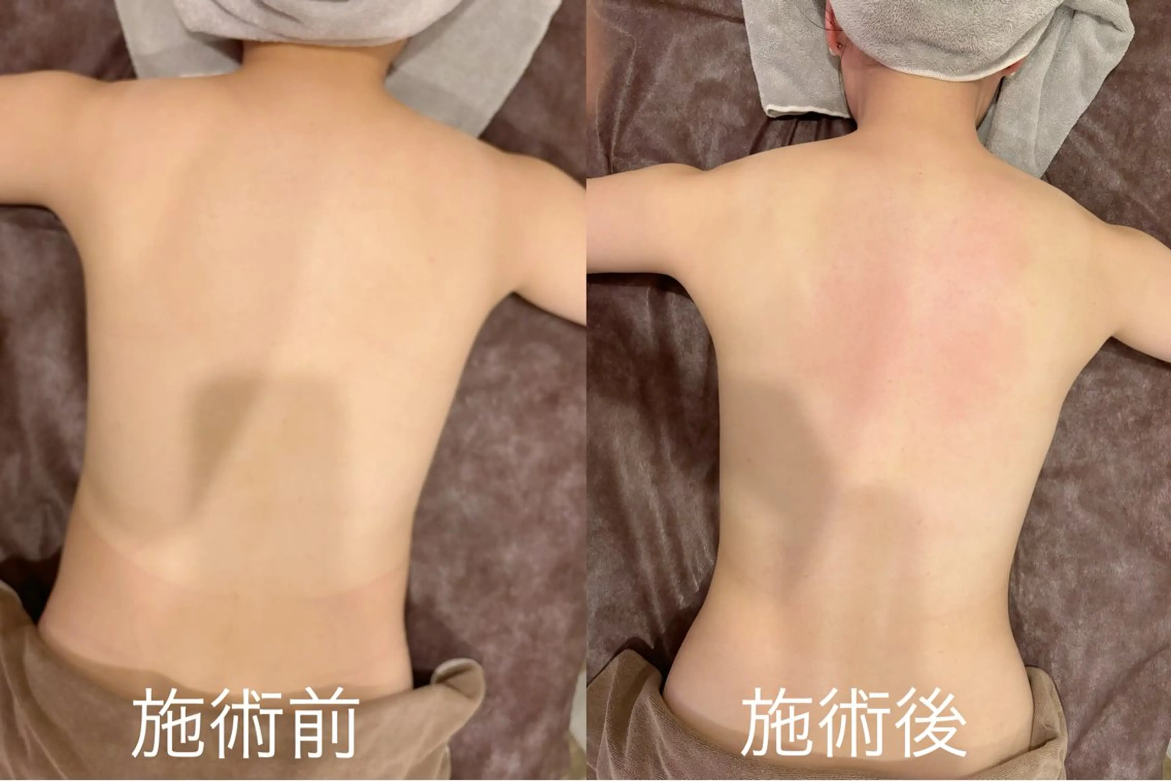 当店人気No.1最新型ハイパーナイフ6⇒ボディ全身かけ放題90分¥21000→¥11600[現金払い¥11400の写真