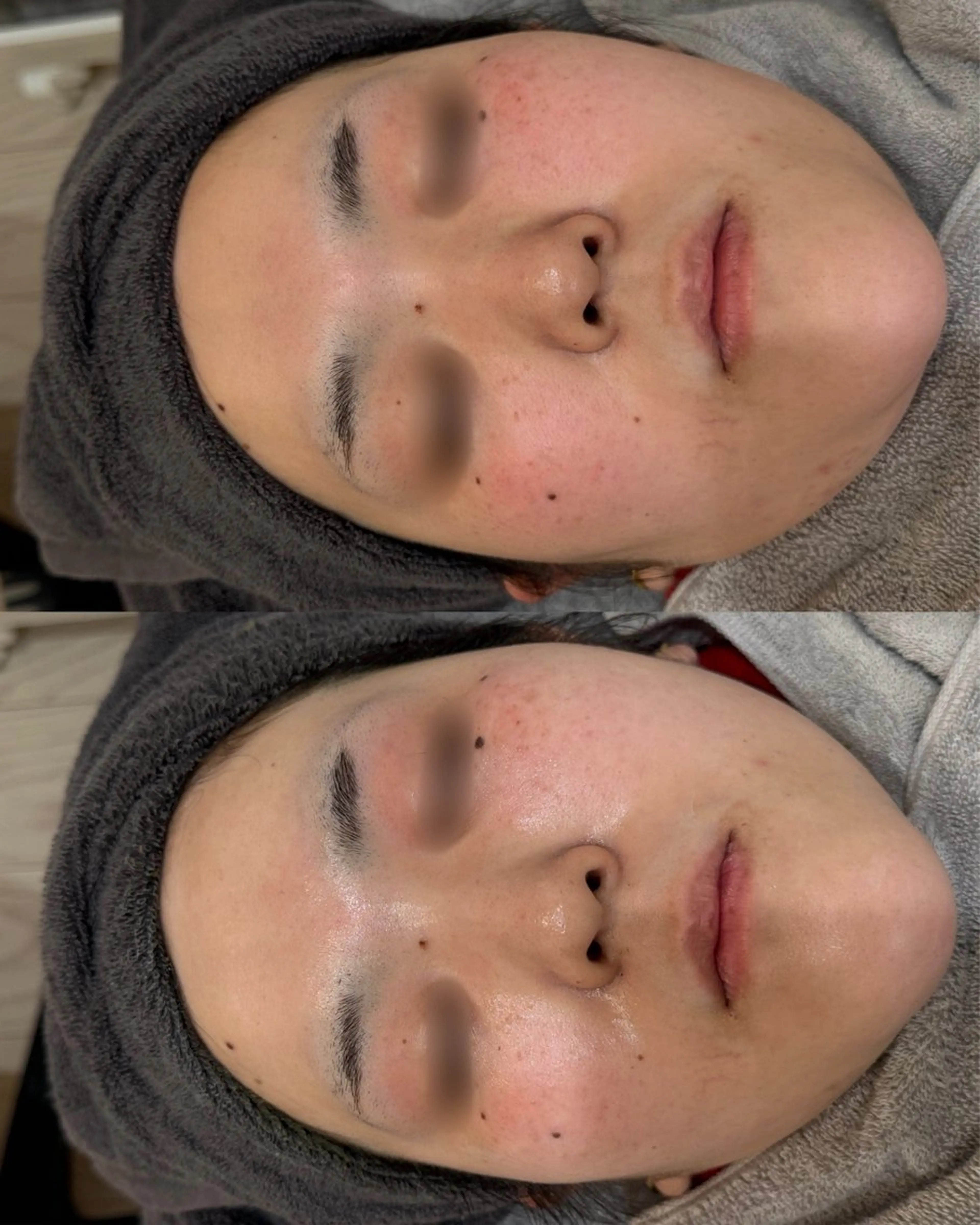 【赤ニキビ・炎症ケア】の写真