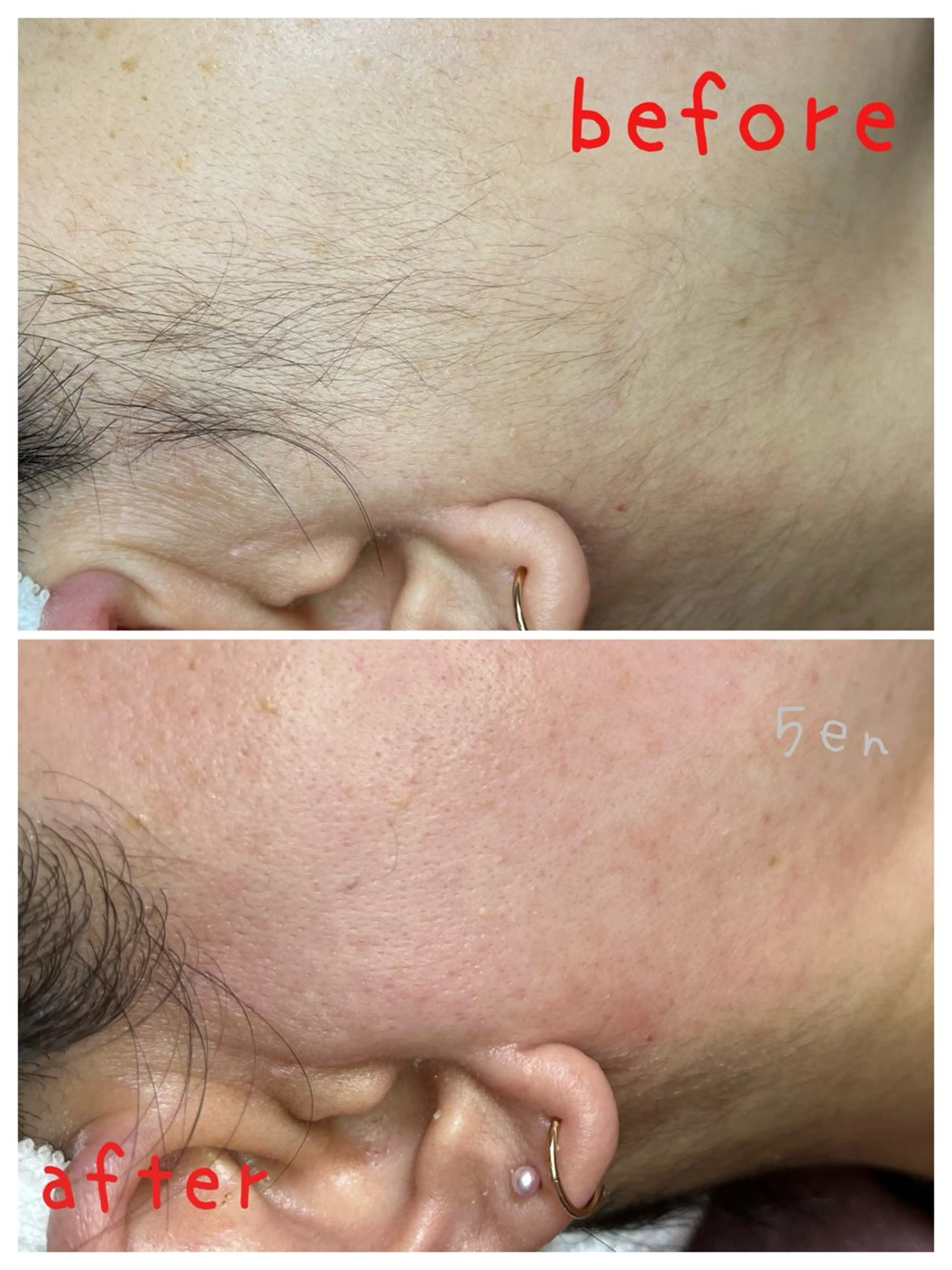 脱毛 シュガーリング/脱毛 EARLS 三軒茶屋のエステ・リラクイメージ