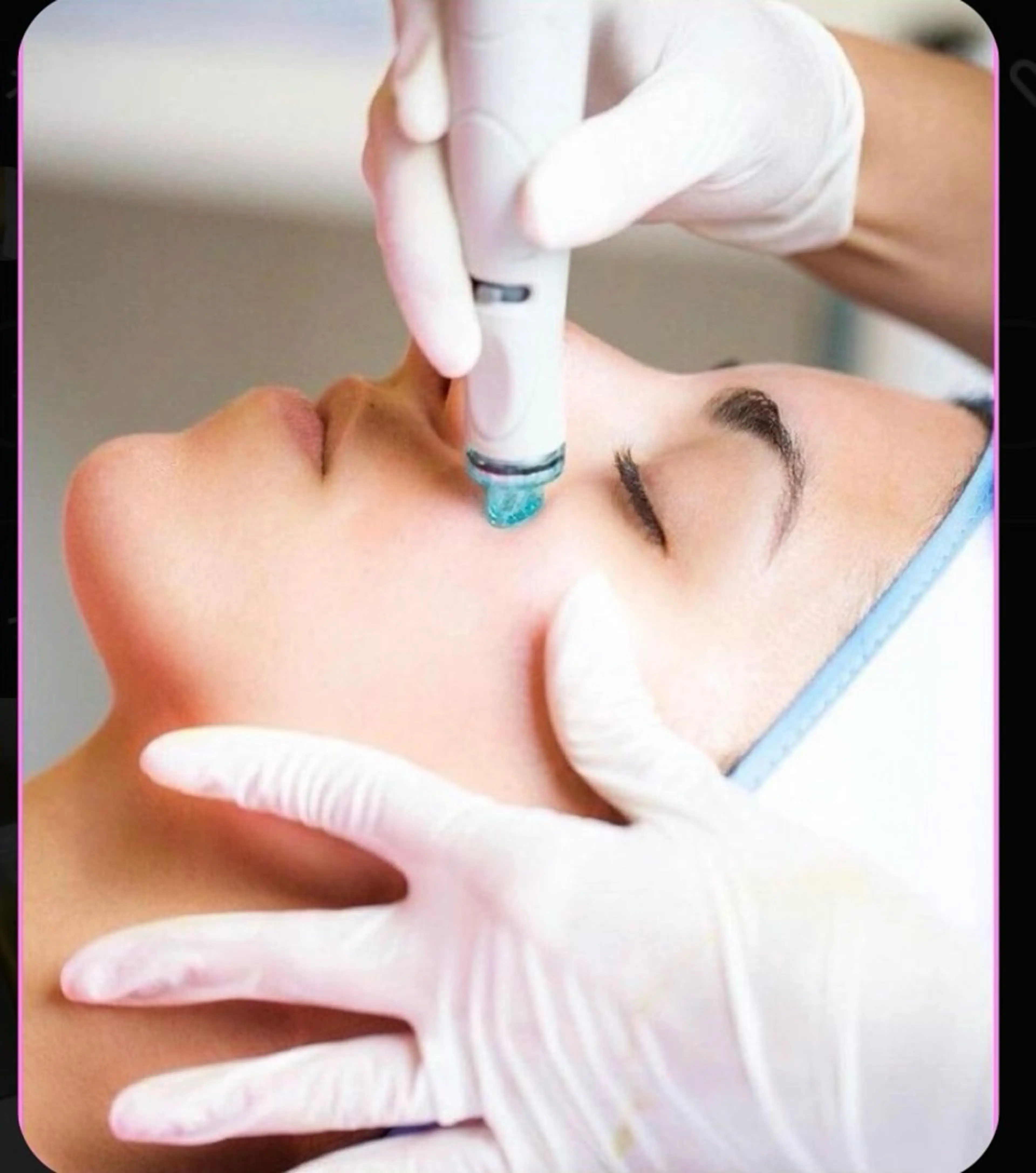 【ハイドラ毛穴洗浄】全顔の写真