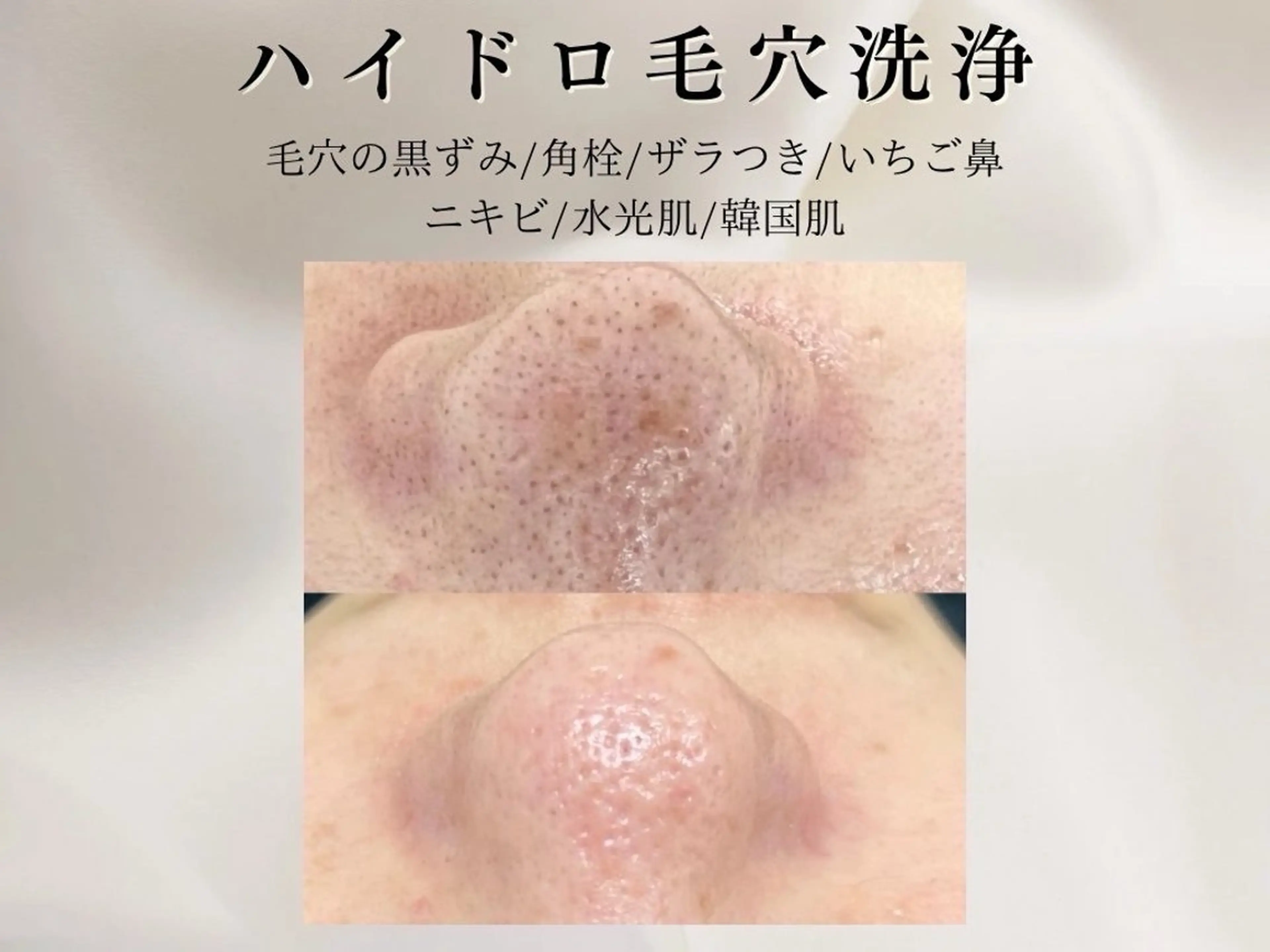 毛穴洗浄◇ハイドロフェイシャル【韓国肌パック仕上げ/鎮静・消炎】の写真