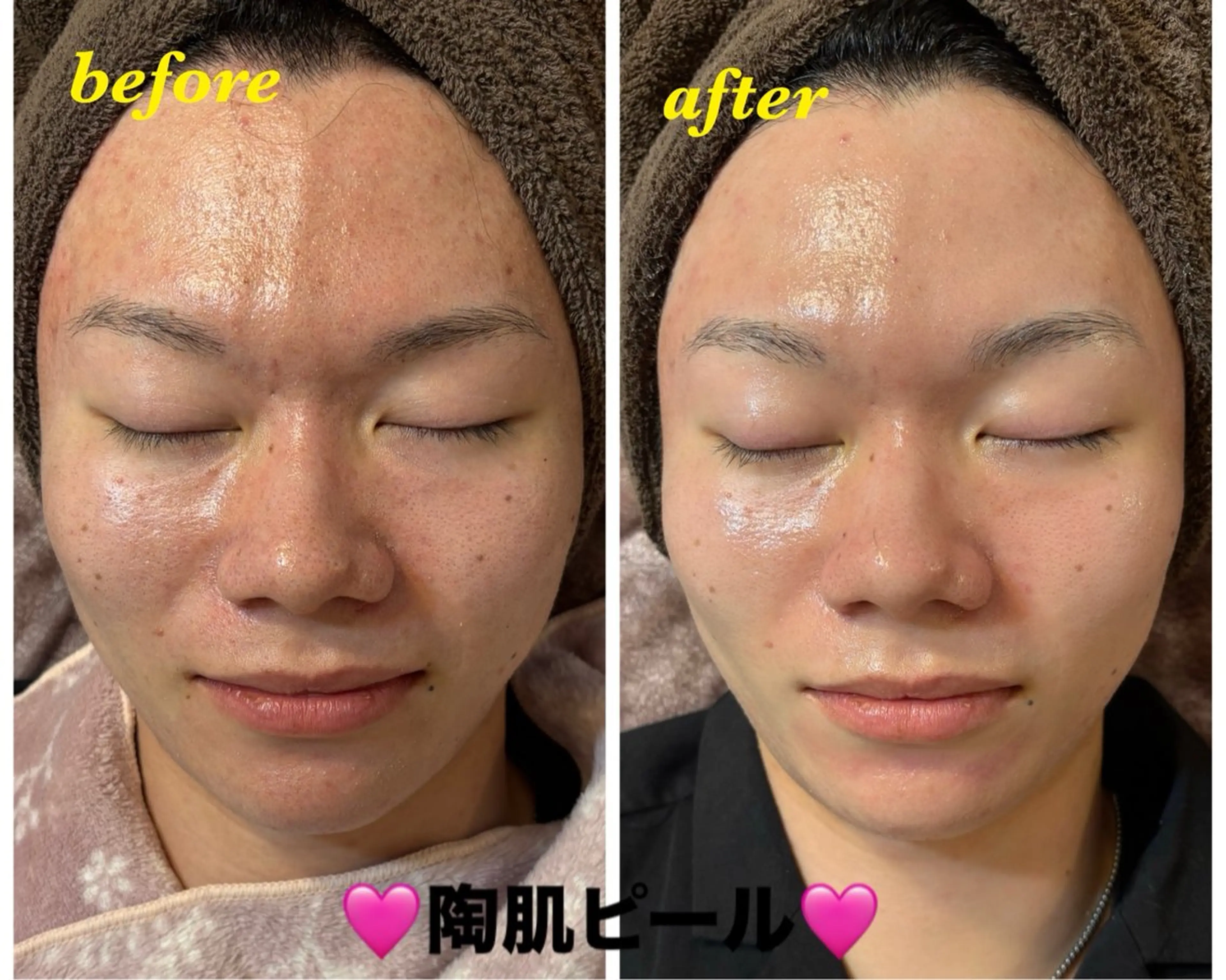 エステ ハーブピーリング専門 毛穴洗浄❤️眉waxのエステ・リラクイメージ