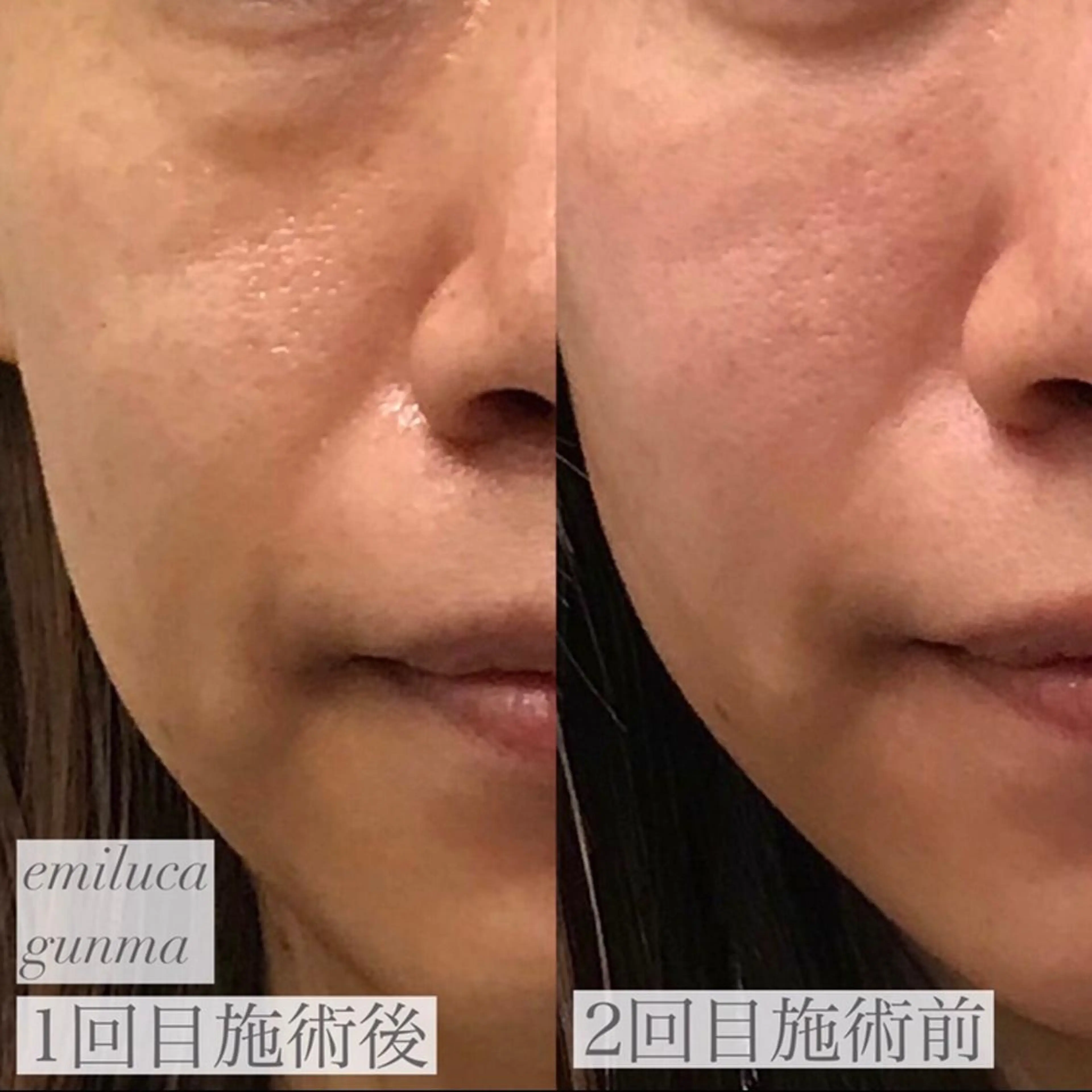 emiluca西目/ 毛穴洗浄/細胞美容のエステ・リラクイメージ