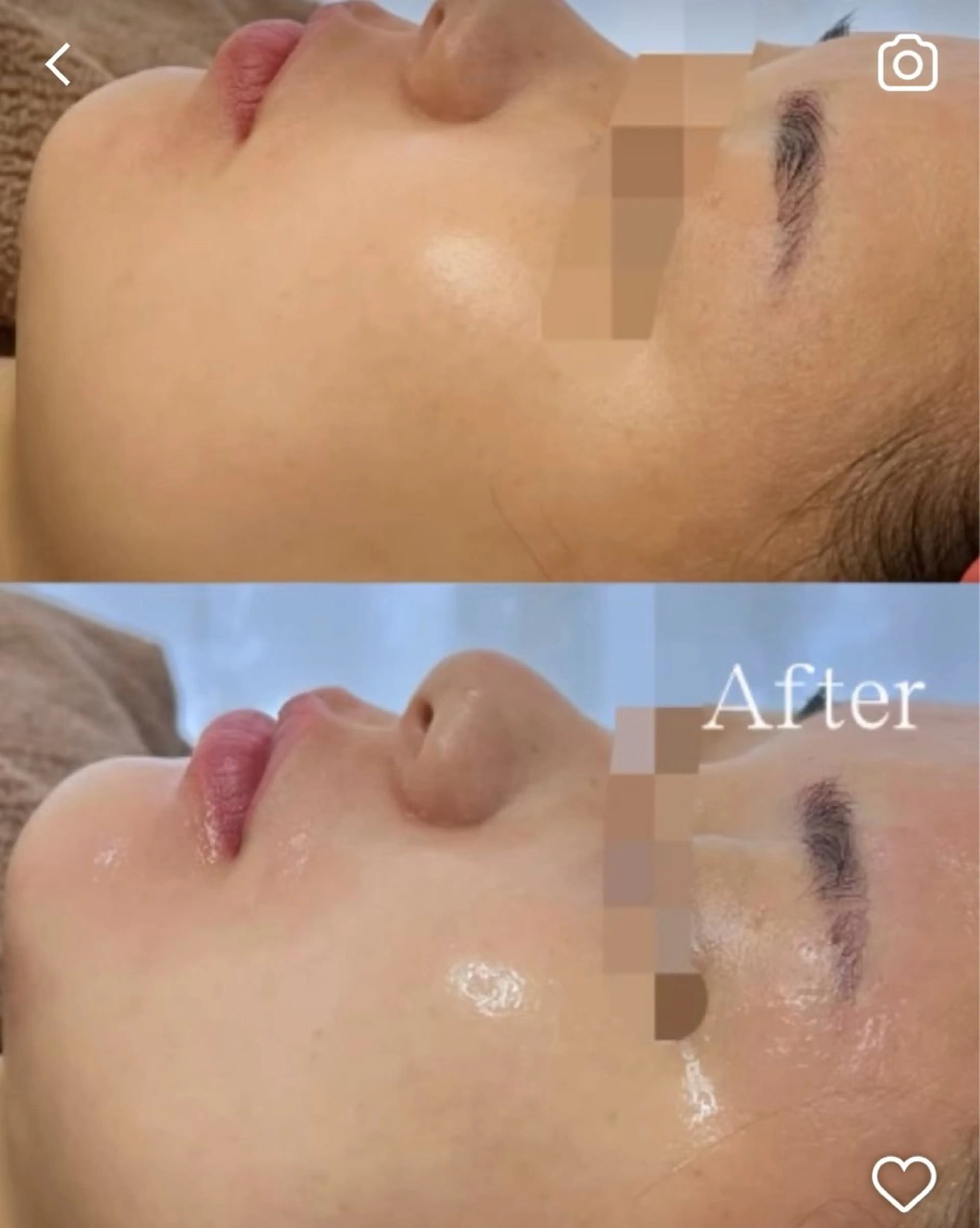 💎お悩みにあった美容液を選択💎【ララピール×アクアダーマ】ピーリング×美容液導入❕これからのお肌作りにおすすめ🪞✨の写真