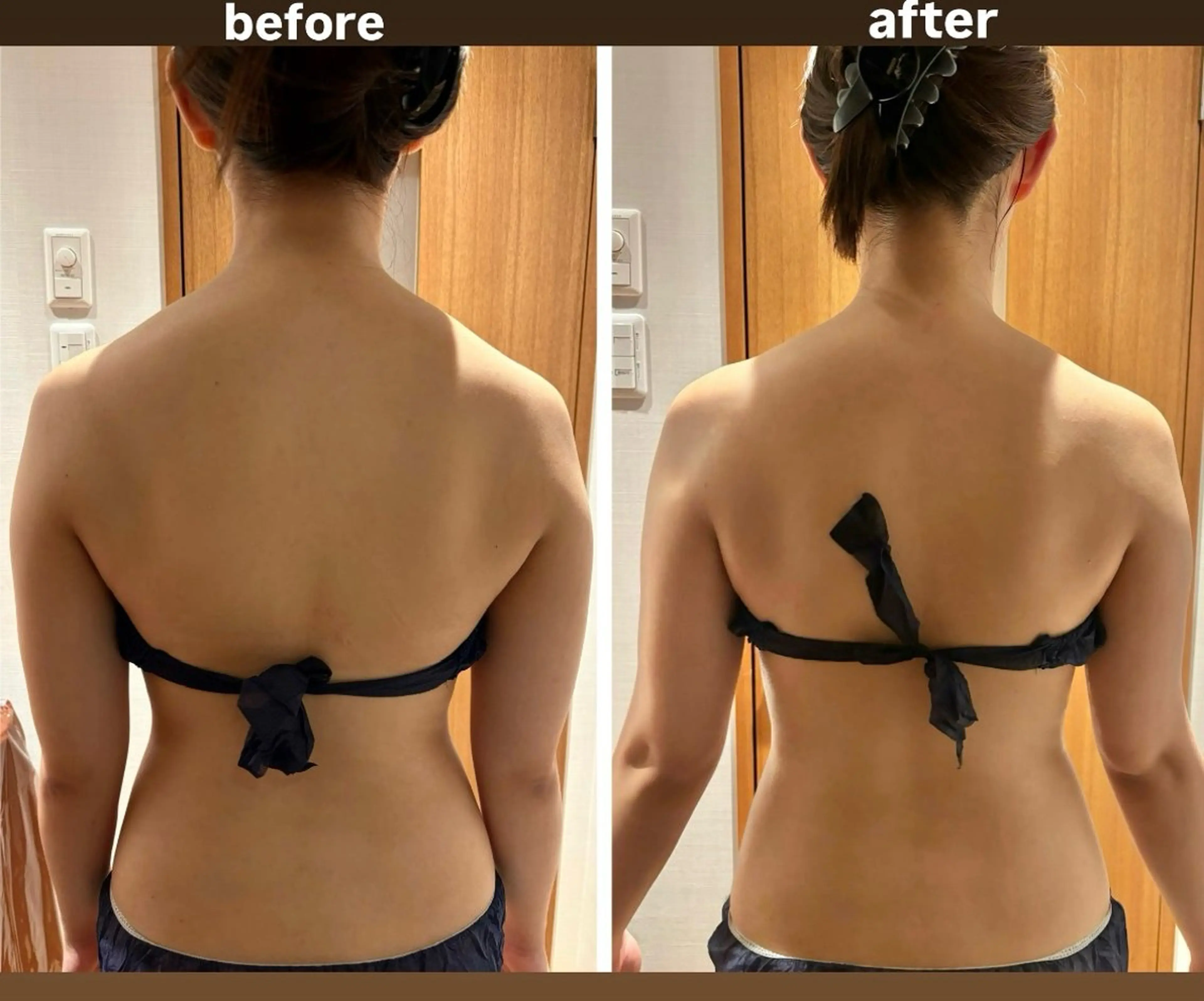 【人気】頑固なセルライト&凝りに❤️🔥ラジオ派で深部温め&吸引で癒着を剥がし、デトックス!心身共に整います✨の写真