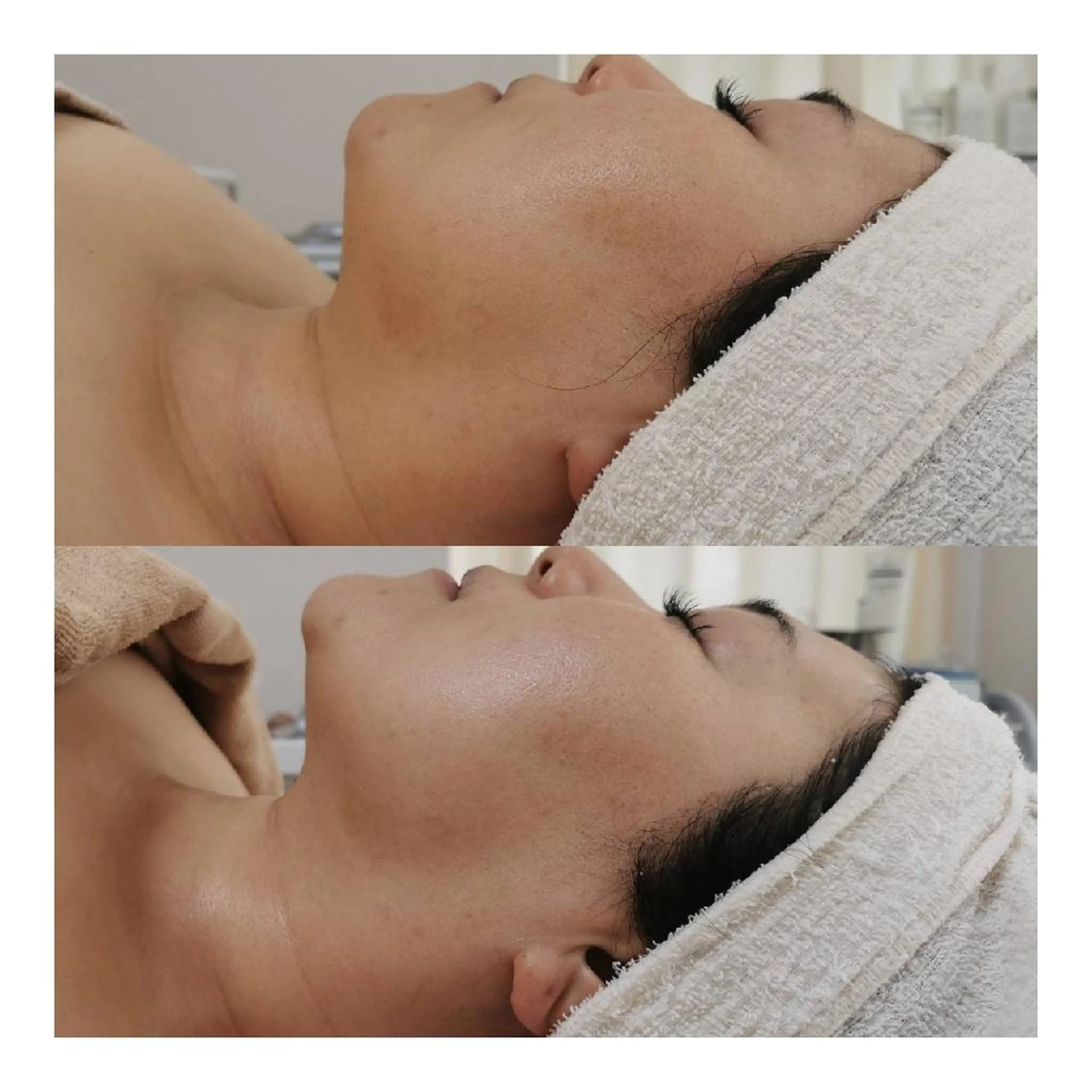 ニキビケア◇ニキビ跡 レゾン京橋店　峠山のエステ・リラクイメージ