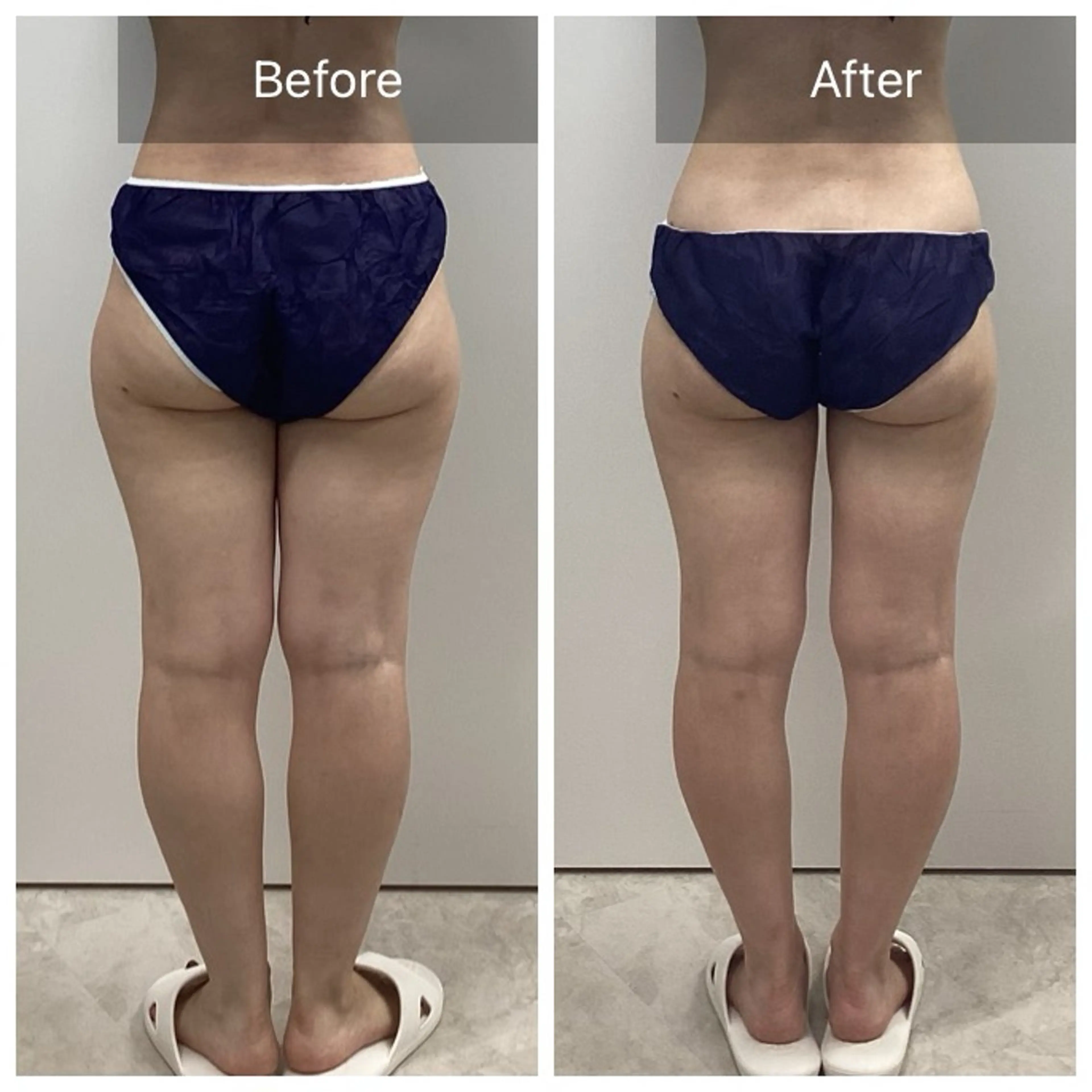 🉐16日以内再来店価格【結果重視◎本気ダイエット】痩身マシン3種＆全身コルギ120分¥24800→12500の写真