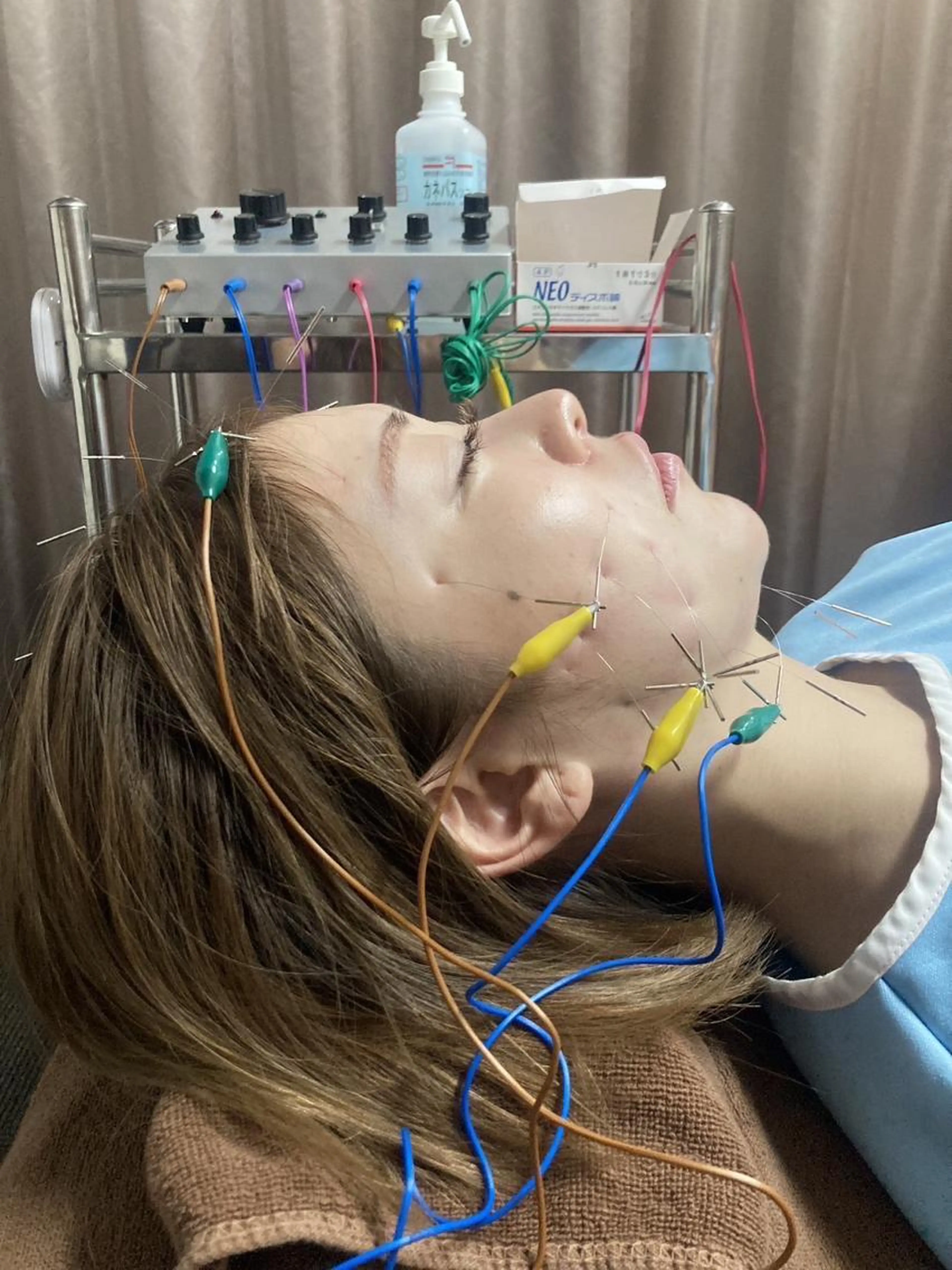 電気美容鍼の写真