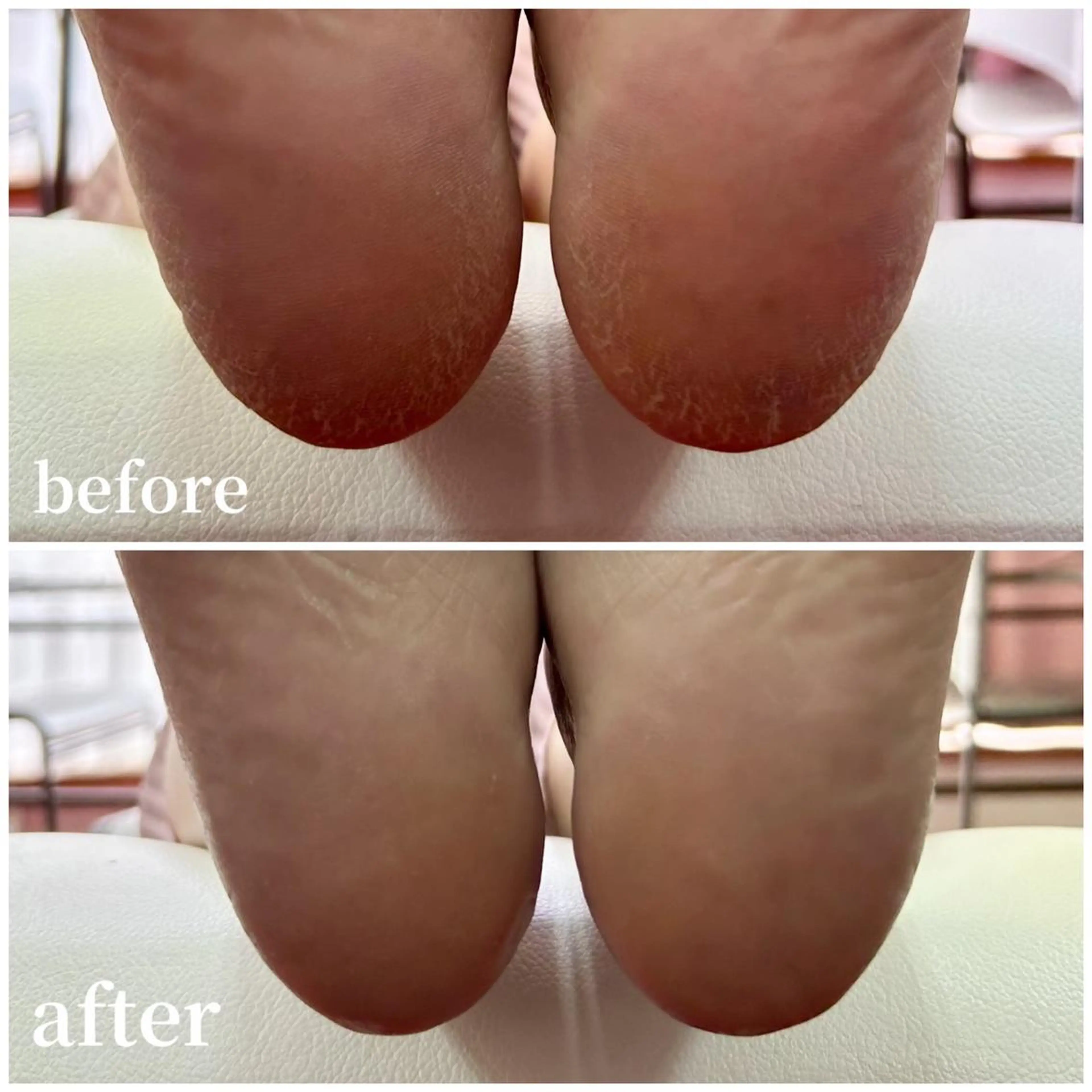 フット角質ケアサンダルが似合うツルツルかかとに♪の写真