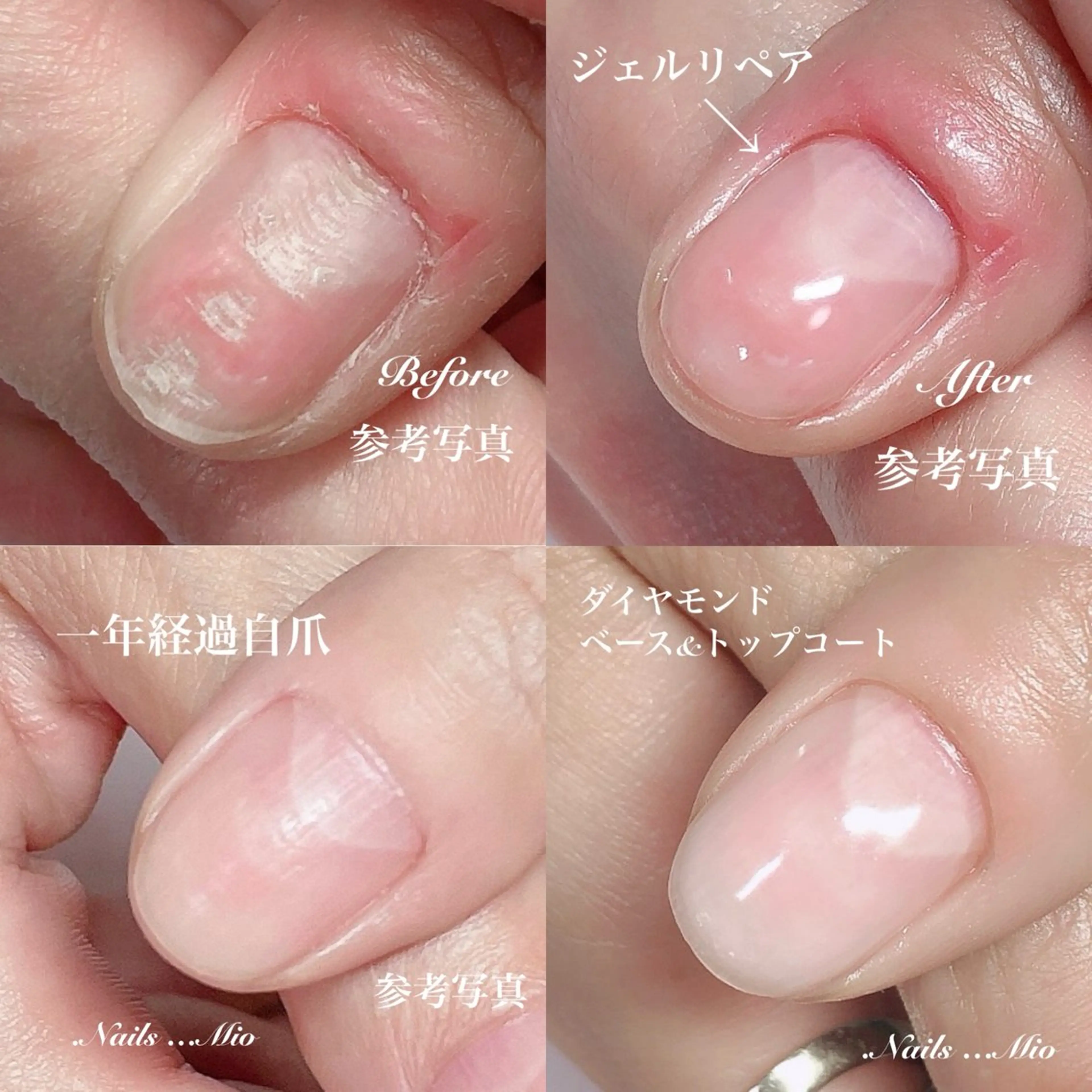 トラブル爪→洗濯板状爪改善コース1本の写真