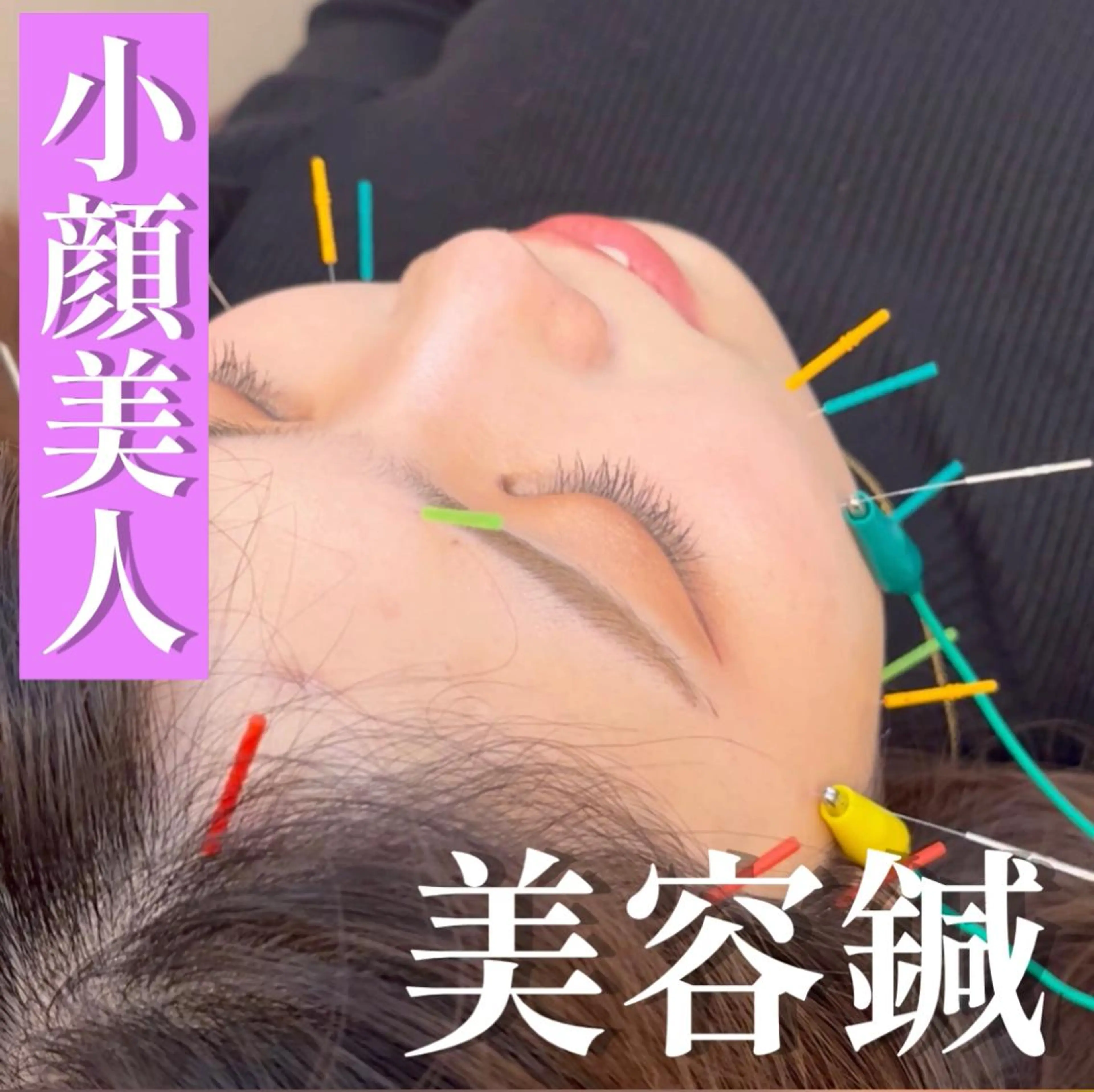 眼精疲労美容鍼👀【電気容鍼🦔】お顔全体の血流up⤴️✨《口コミ投稿で¥500オフ🍃》の写真