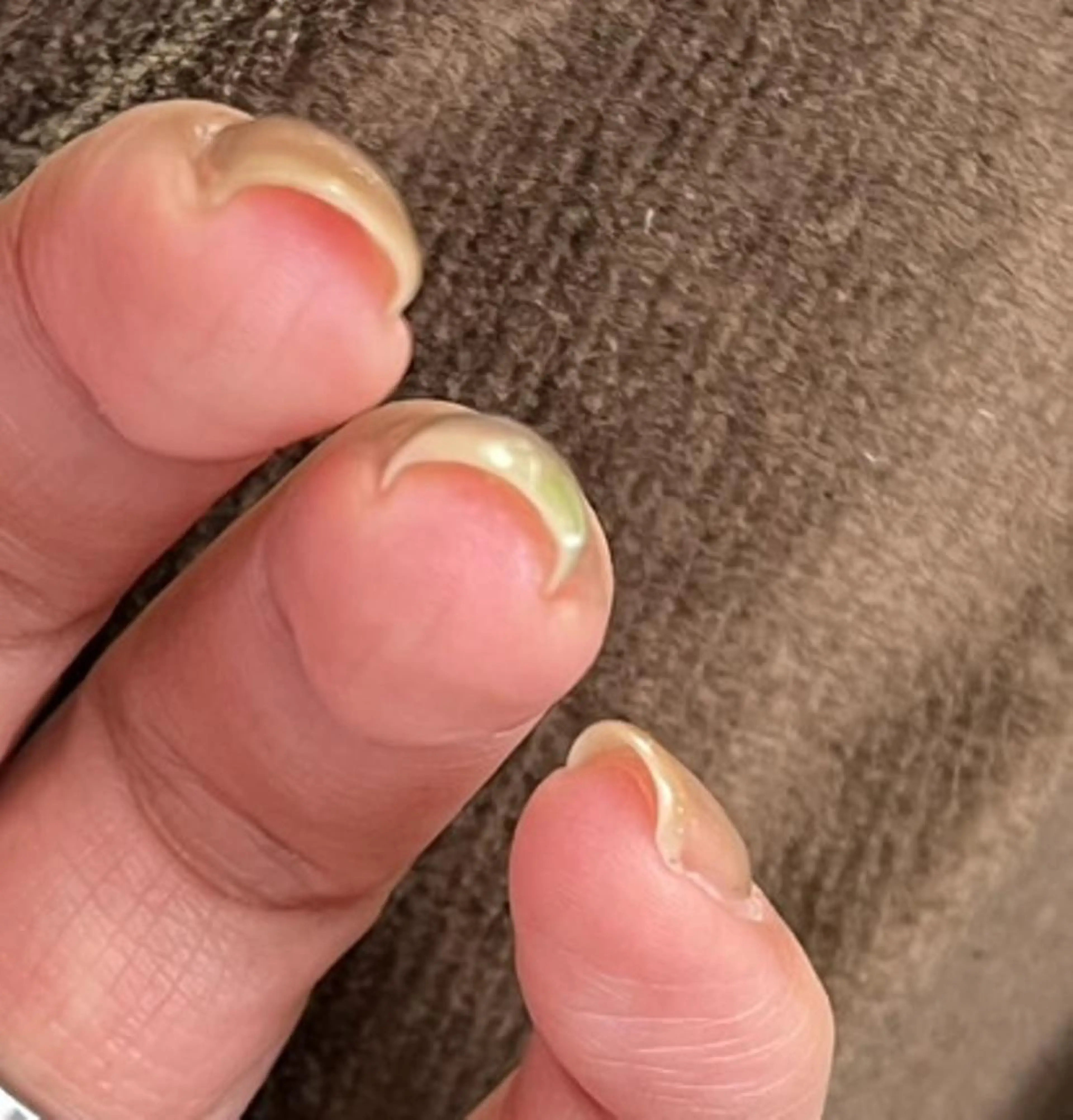 手の巻き爪が気になる方:モニター様募集の写真