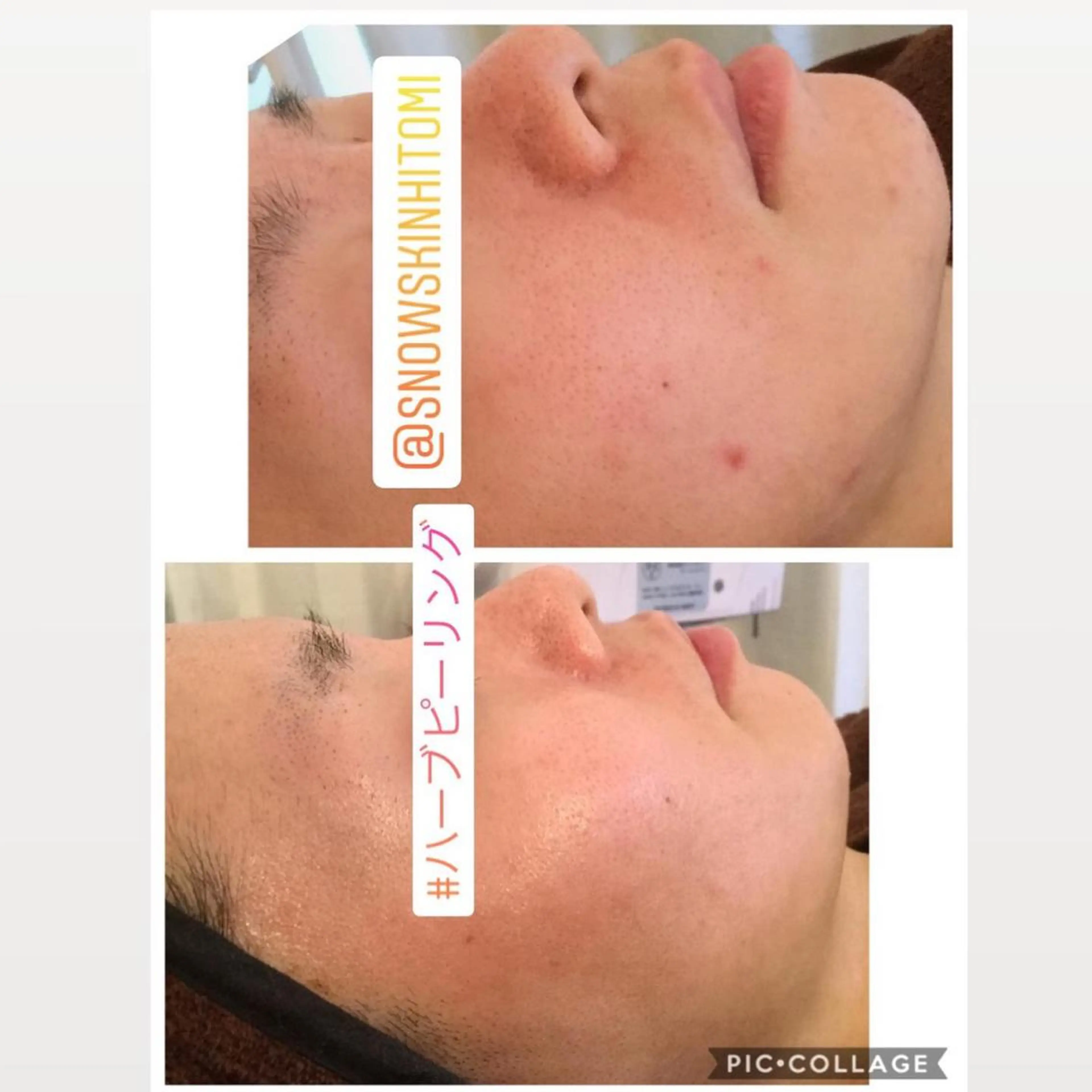 エステ リラク ニキビ/肌質改善専門 Snow skinのエステ・リラクイメージ