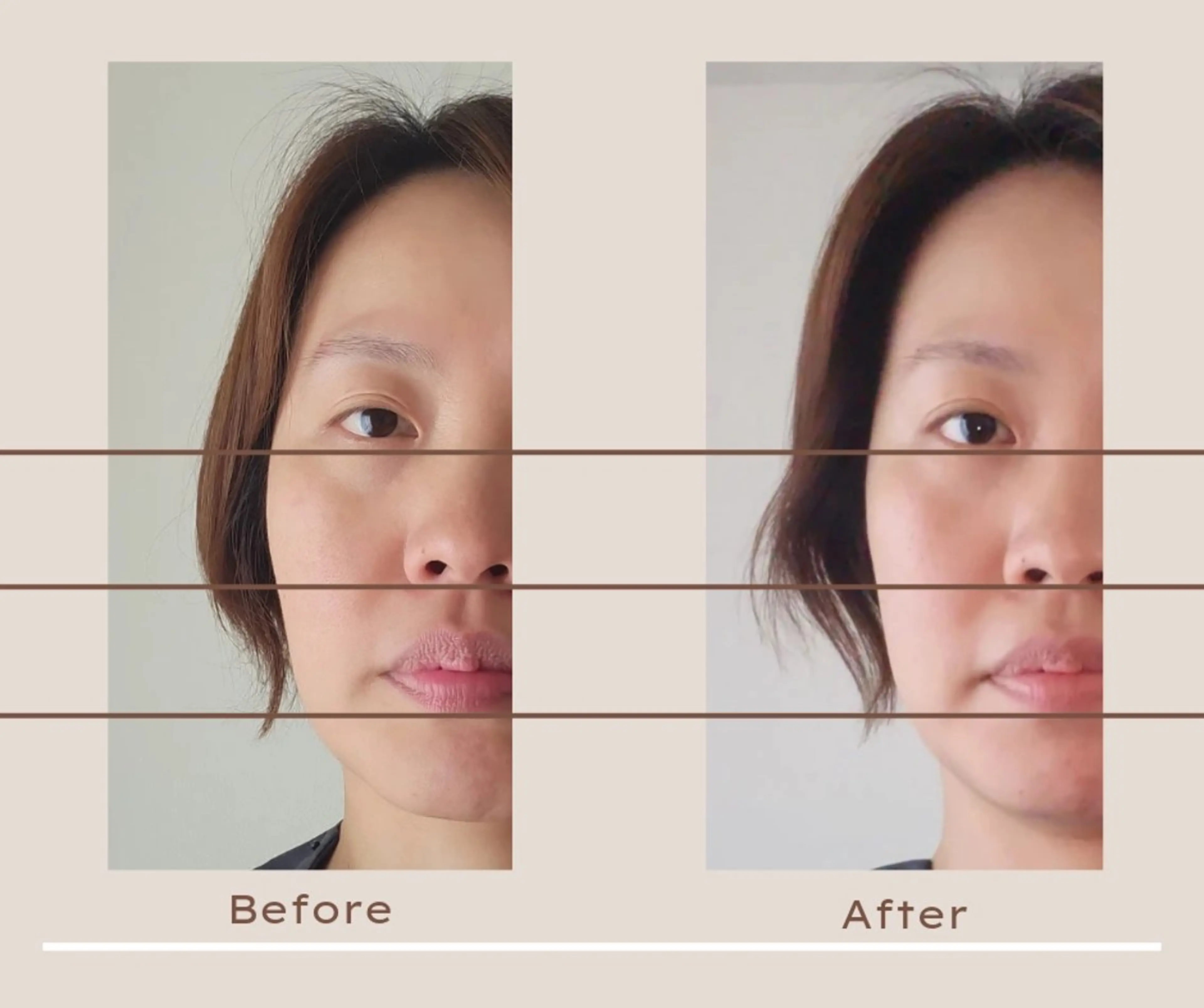 即効⚡小顔美容鍼🪡 むくみたるみ脂肪解消のエステ・リラクイメージ