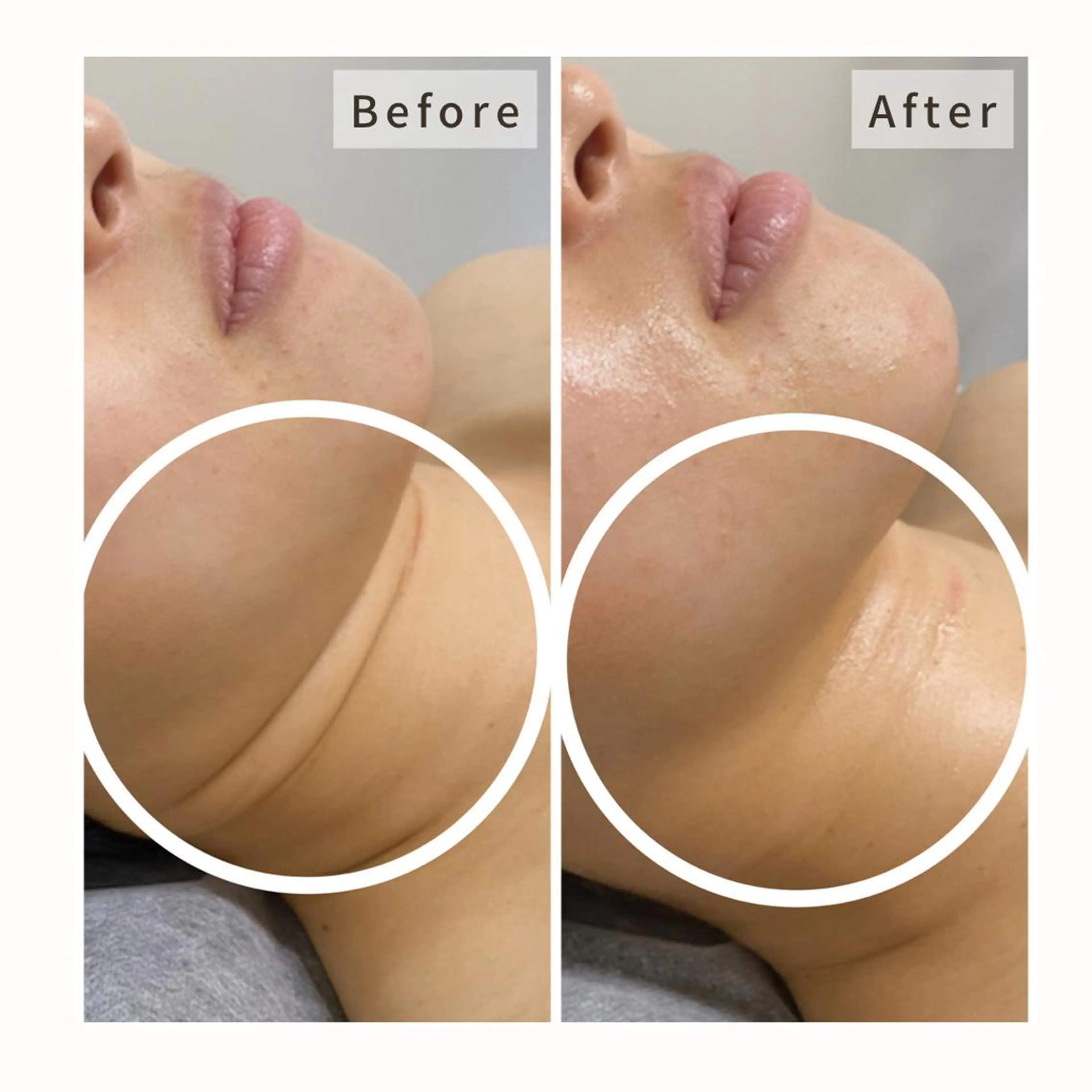 特別価格‼️【シワ•たるみケア】REVI ハーブピーリング🌿塗るボトックスでシワ•たるみをケア💛オプション付の写真