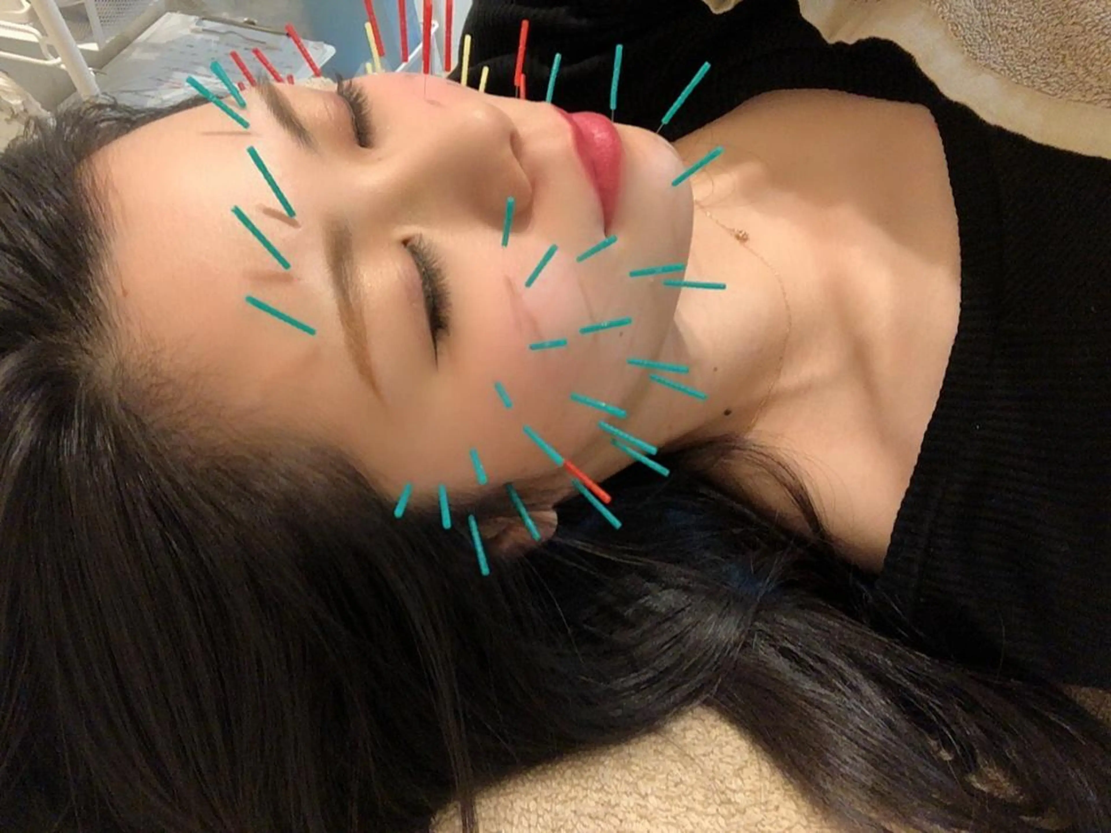 スタンダード美容鍼の写真