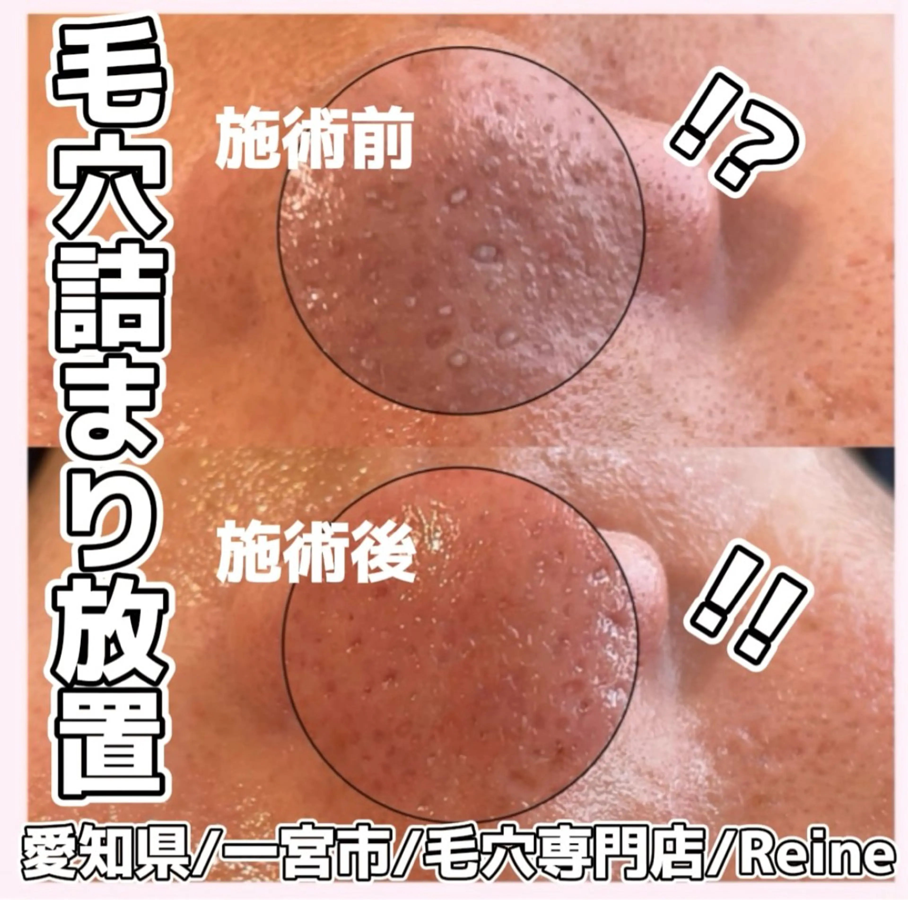 毛穴/シミ肝斑/脱毛 横山梨里のエステ・リラクイメージ