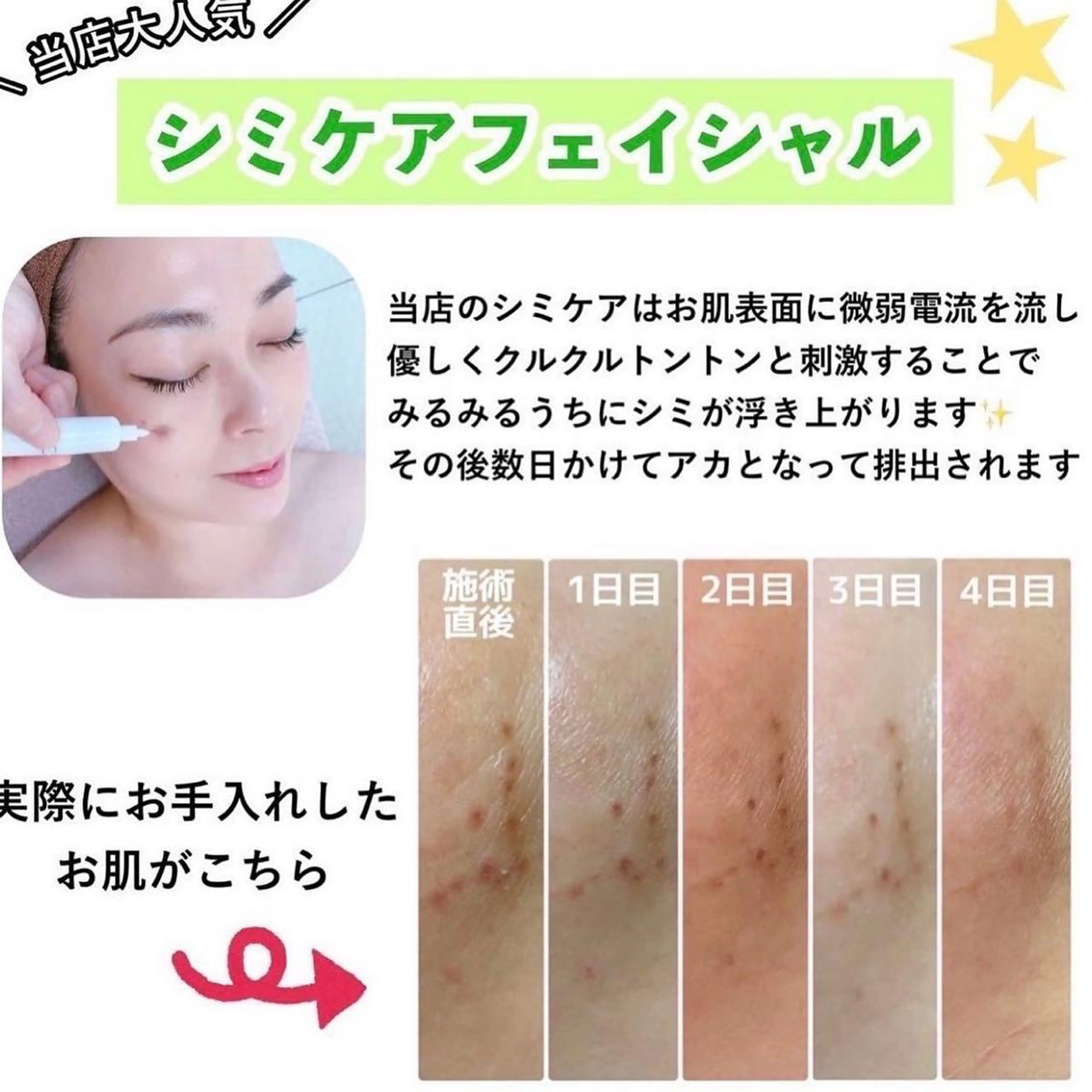 【ニキビ/肌管理】 salon varyのエステ・リラクイメージ