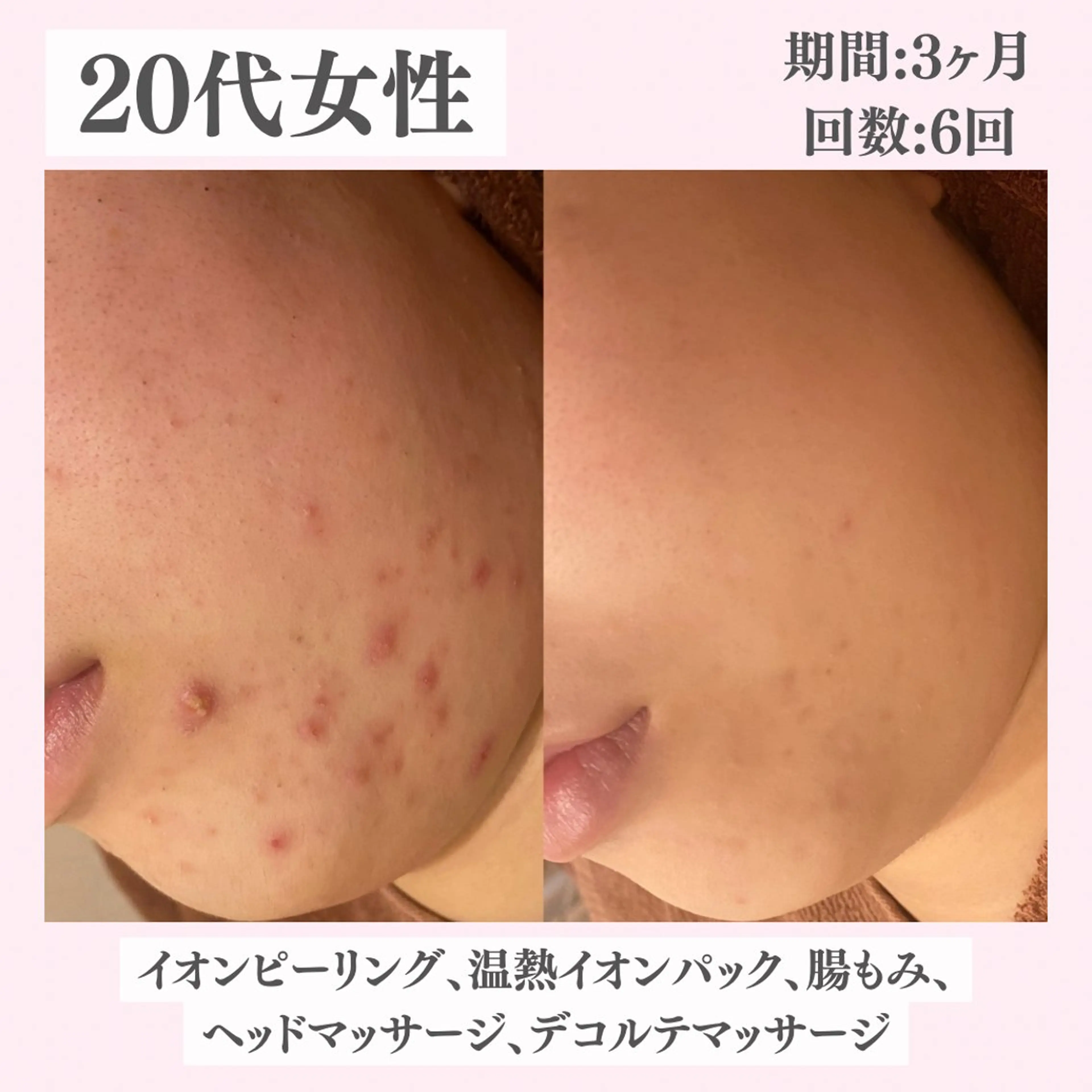 エステ リラク ニキビ・肌質改善専門 ♡人生が変わるサロンのエステ・リラクイメージ