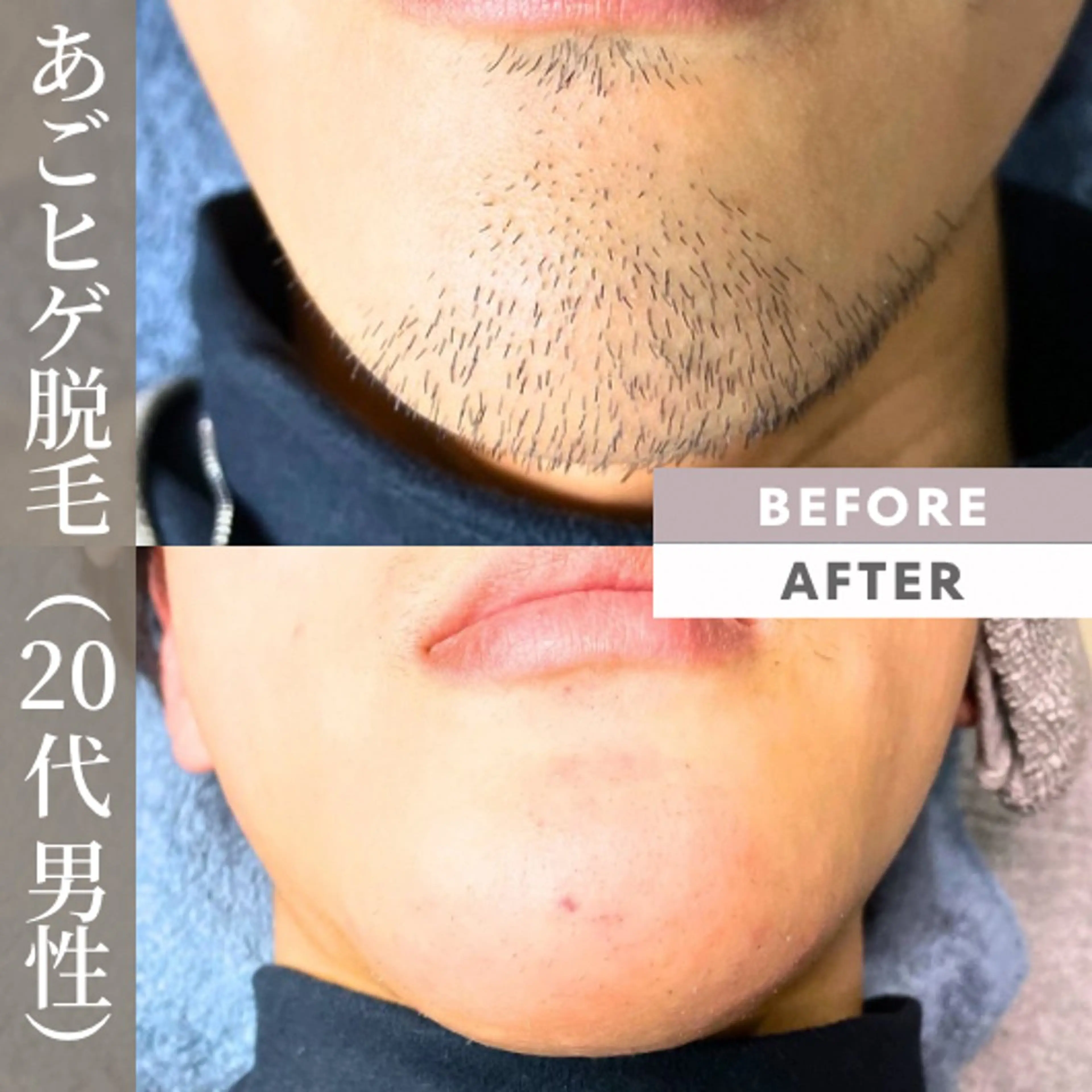 メンズ 【一本ずつ脱毛】 ReMove 柏のエステ・リラクイメージ