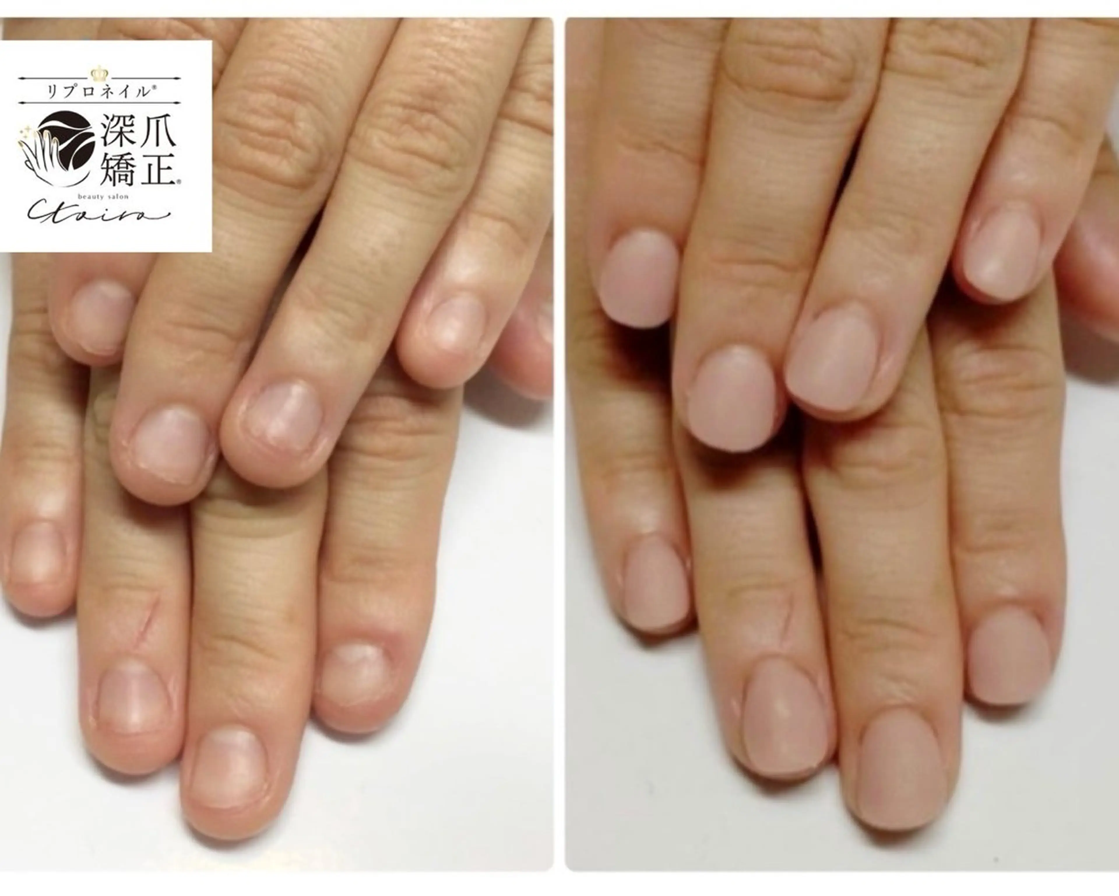 メンズ ネイル フットネイル 深爪矯正専門店　ネイルサロン　トイロ所属・ネイルサロン トイロのネイルデザイン