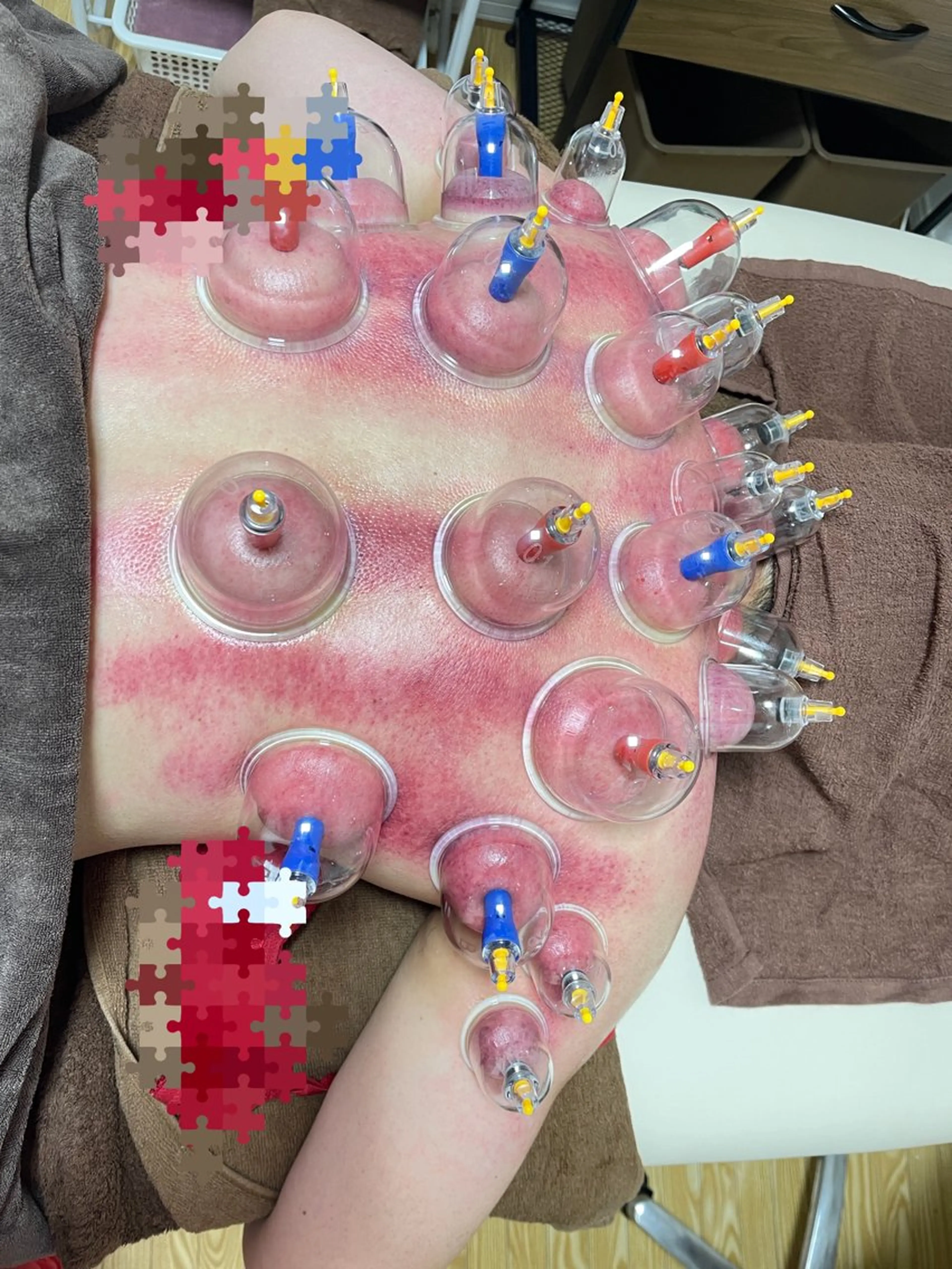 オイル＋カッサ＋カッピングの写真