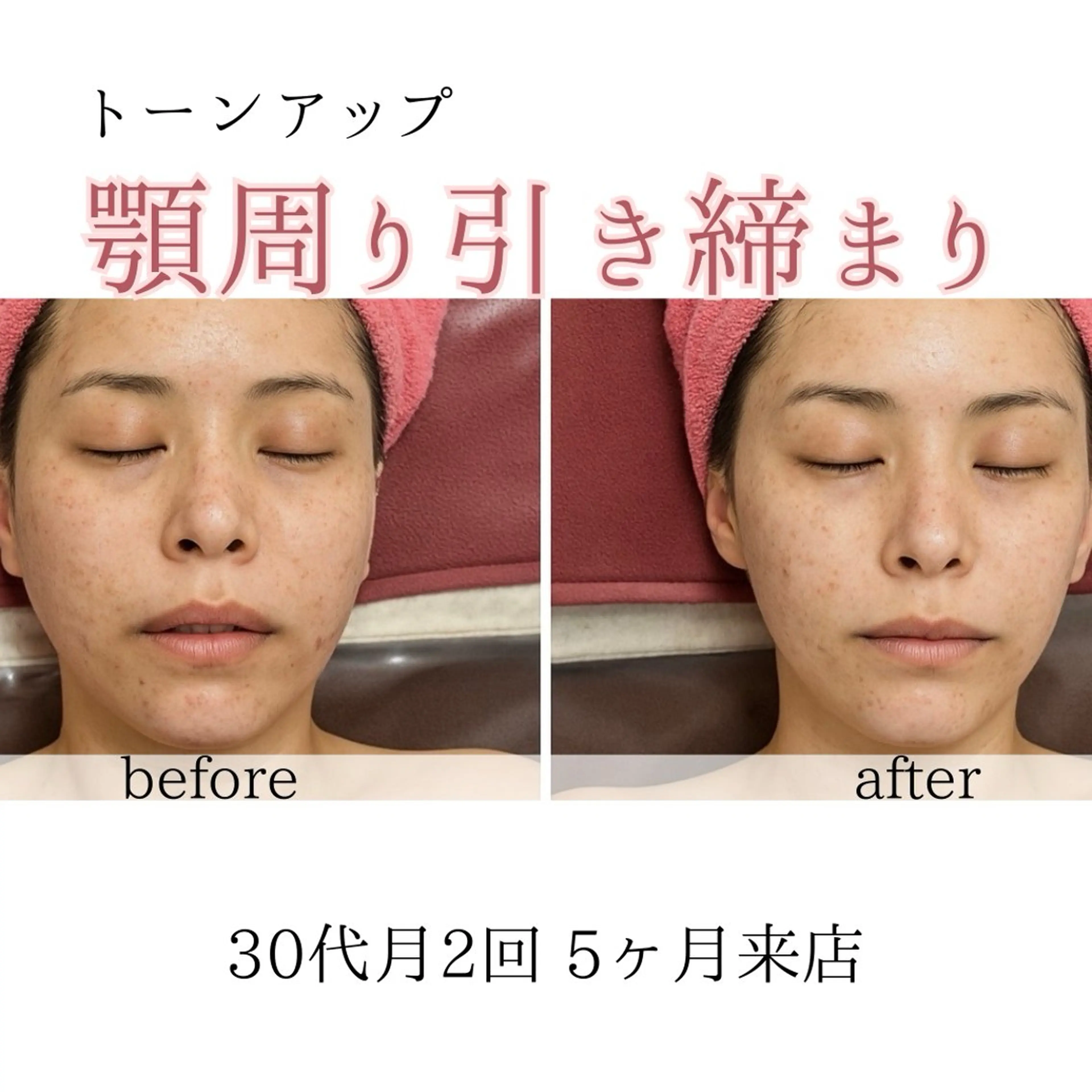 オアシス・さくら所属・小顔（シミ ニキビ）脱毛サロンのエステ・リラクイメージ