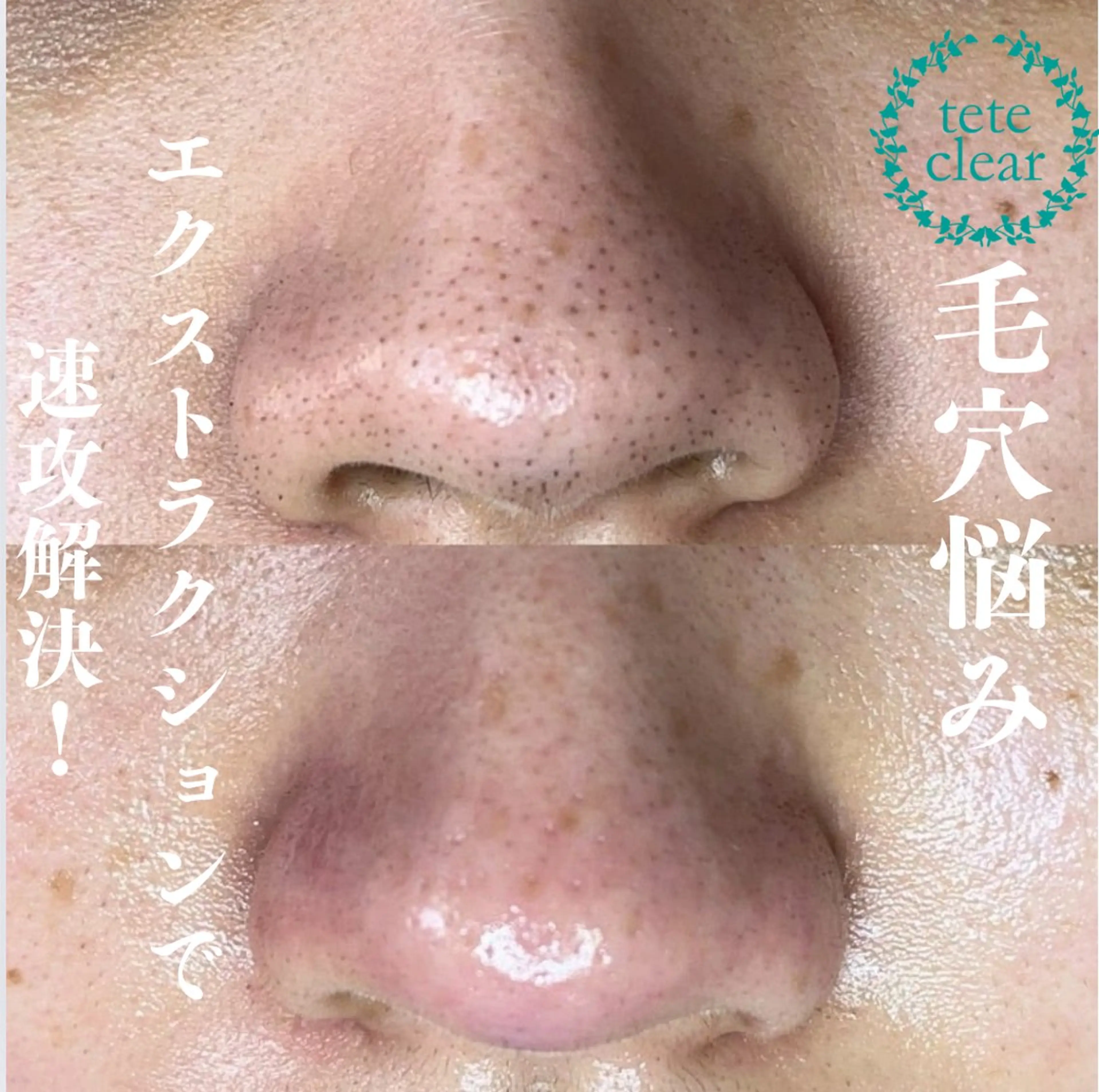 【取れた角栓が見える★】ミニモ限定★毛穴エクストラクション+その場で作る生パックプレゼントの写真