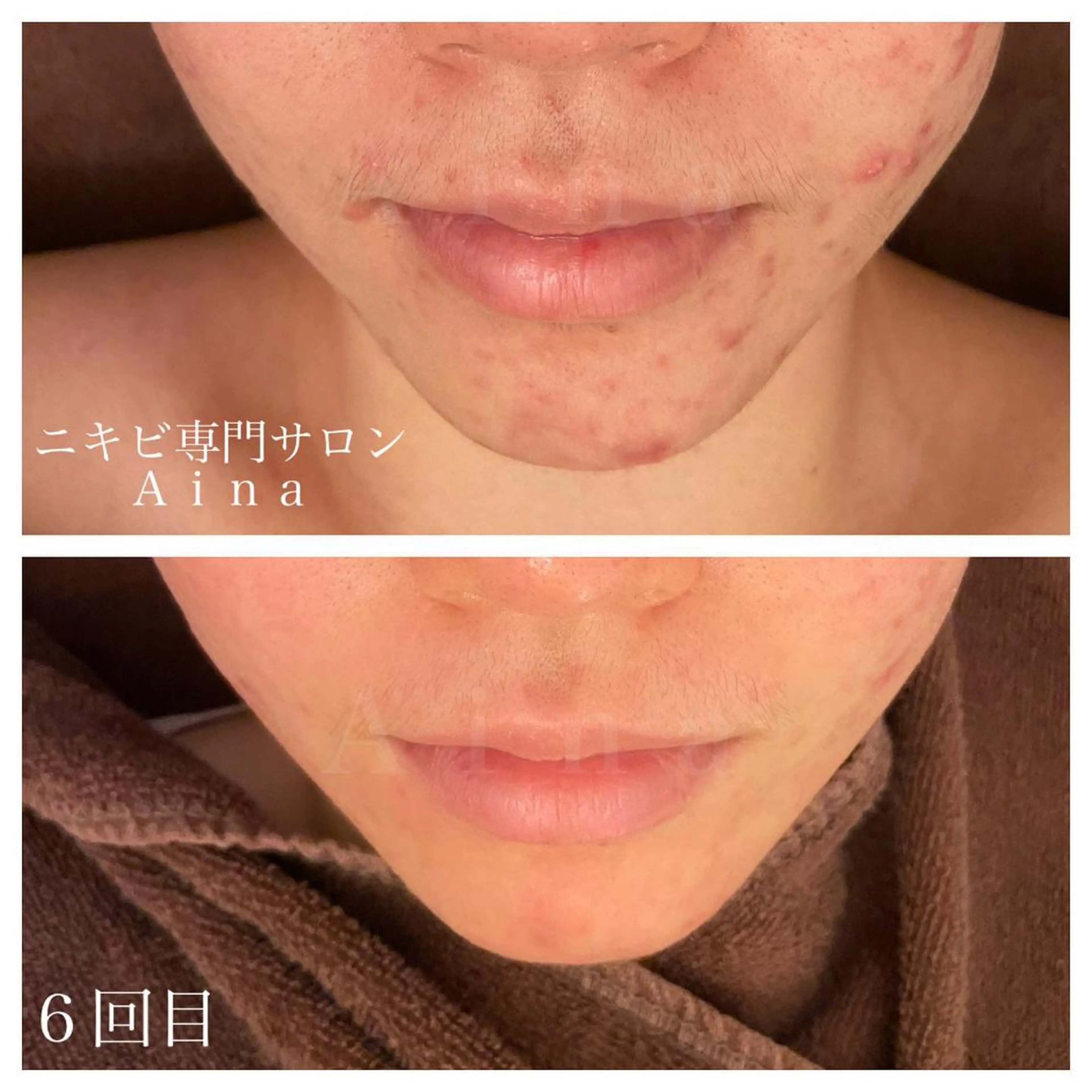 セミロング パーマ ヘアアレンジ メンズ キッズ ネイル マツエク・マツパ 卒業式のヘアスタイル 卒業式 エステ リラク ニキビ跡専門サロン Ａｉｎａのエステ・リラクイメージ