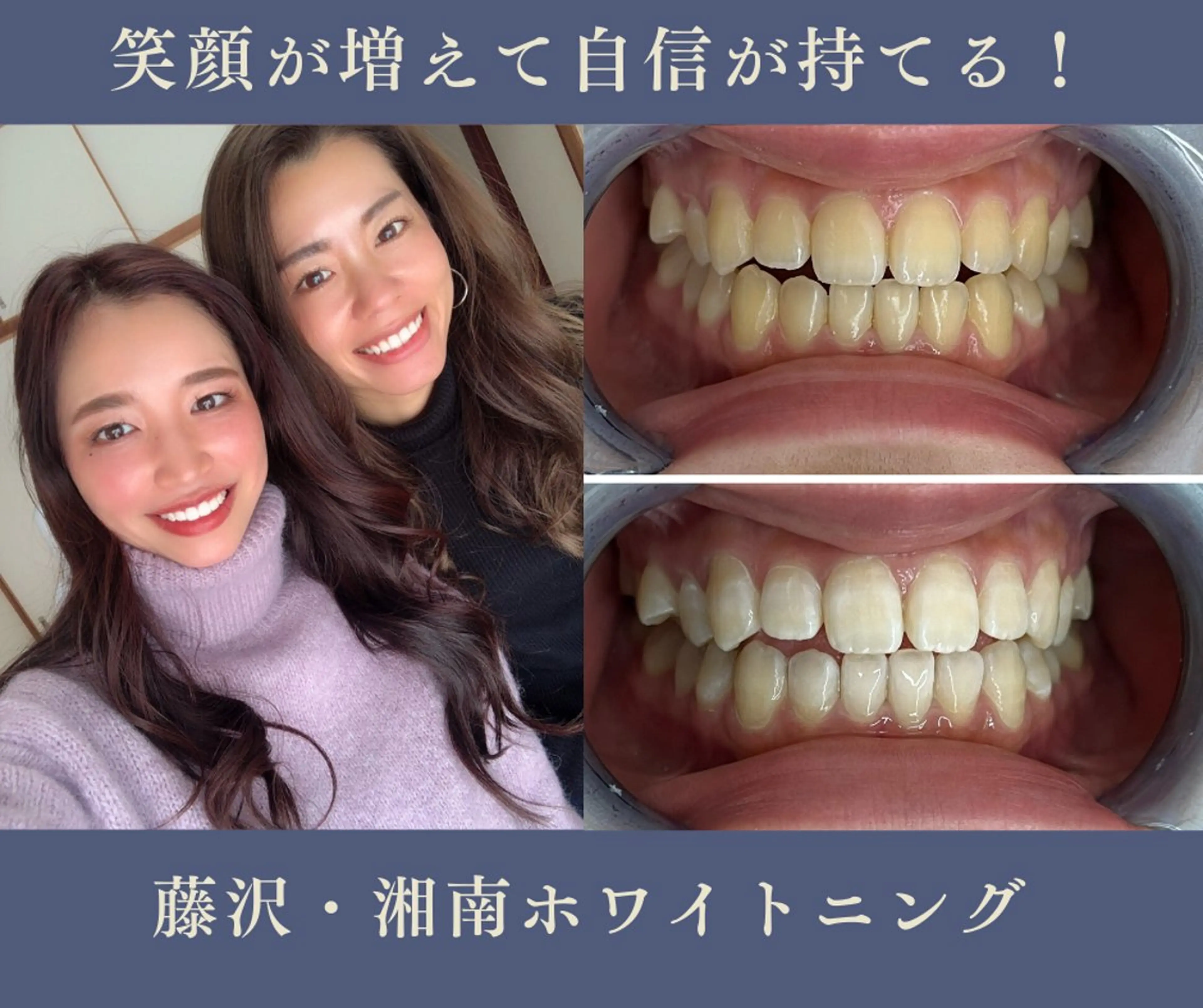 2人でホワイトニング♪20分8.800円🦷✨の写真