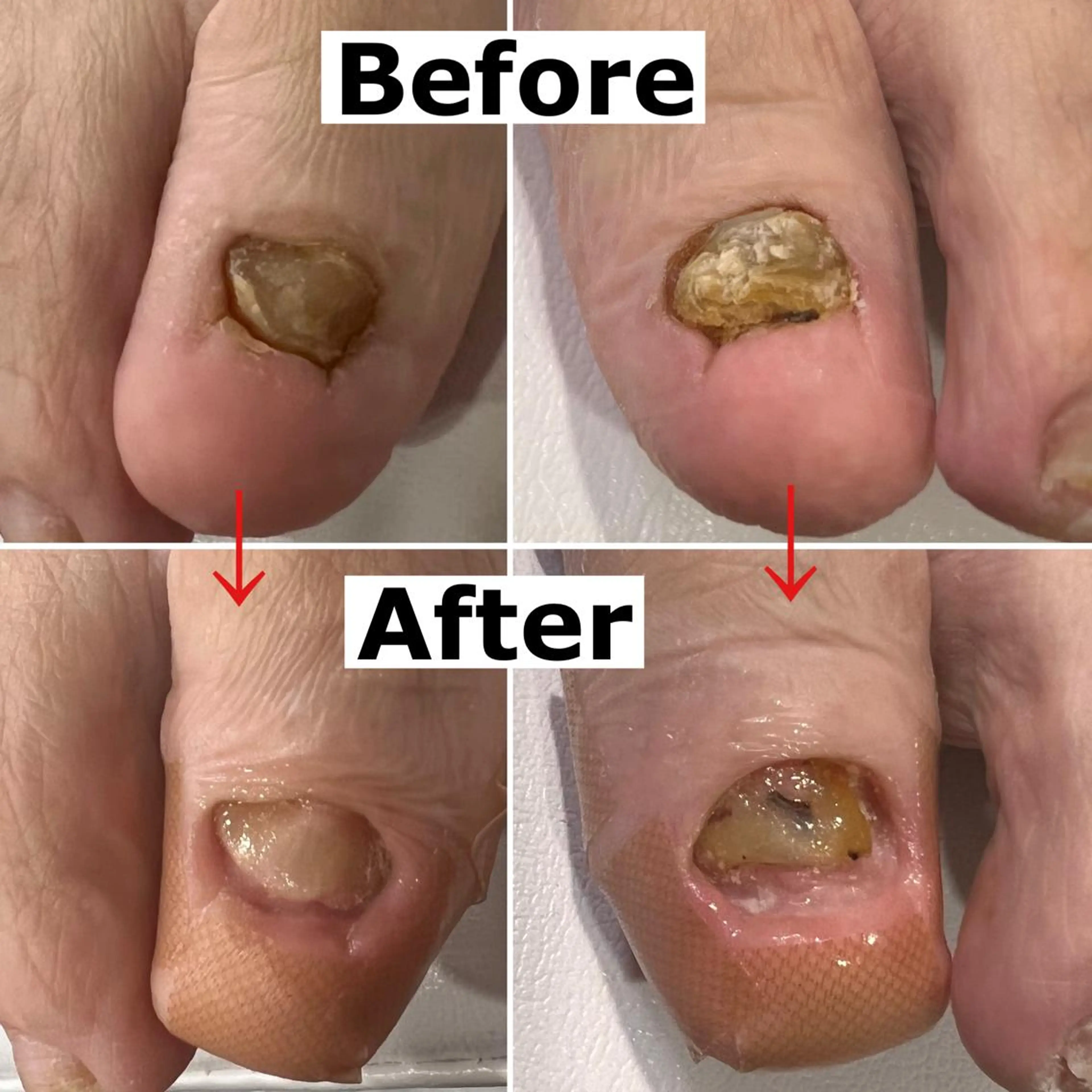 ネイル 巻爪無料モデル募集 ✨🦶MEGUMIのネイルデザイン