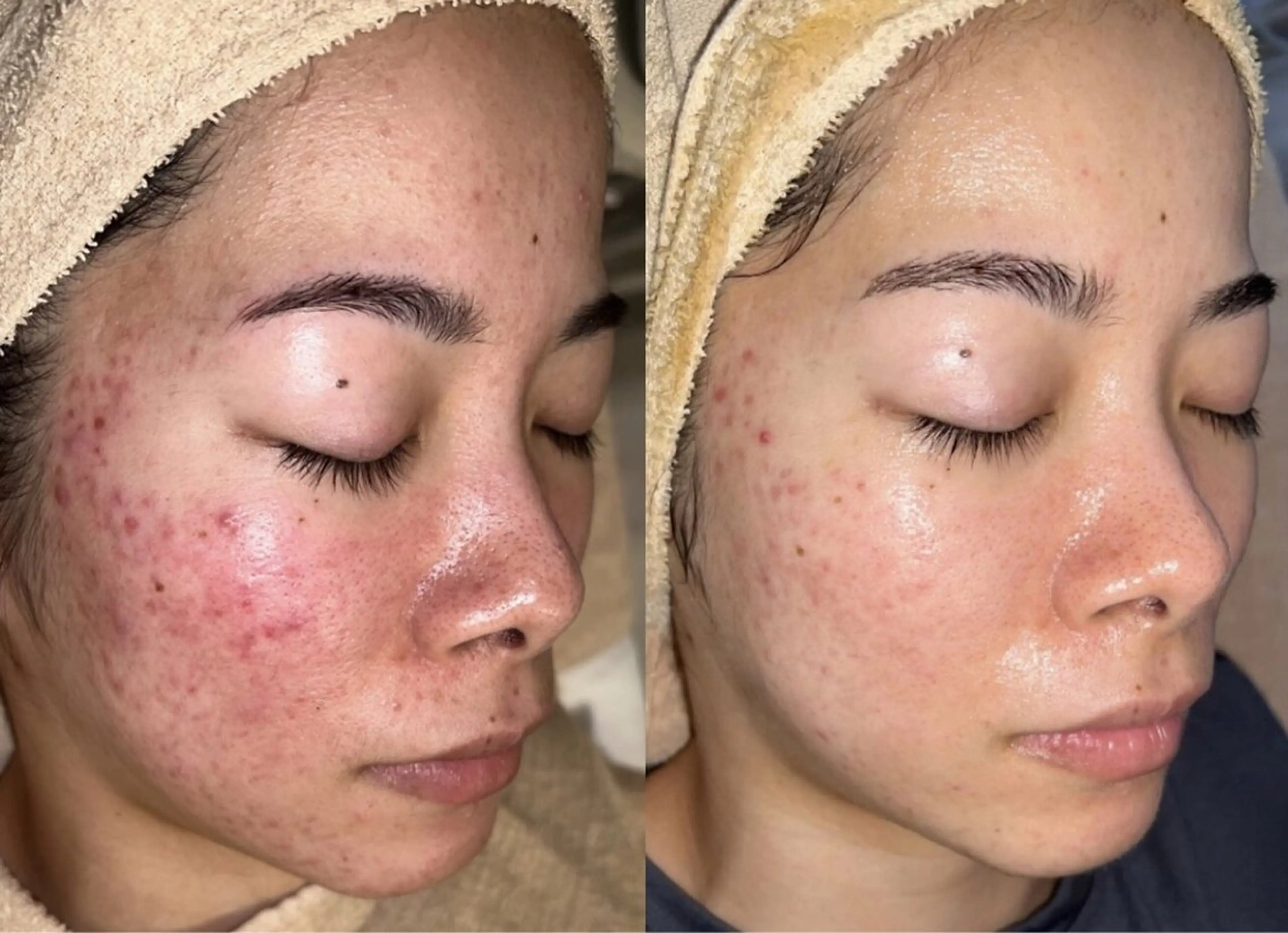 ハーブピーリング /毛穴ケア/脱毛/韓国ツヤ肌専門店【HARU.】所属・全身脱毛/韓国ツヤ肌 ハーブピーリングのエステ・リラクイメージ