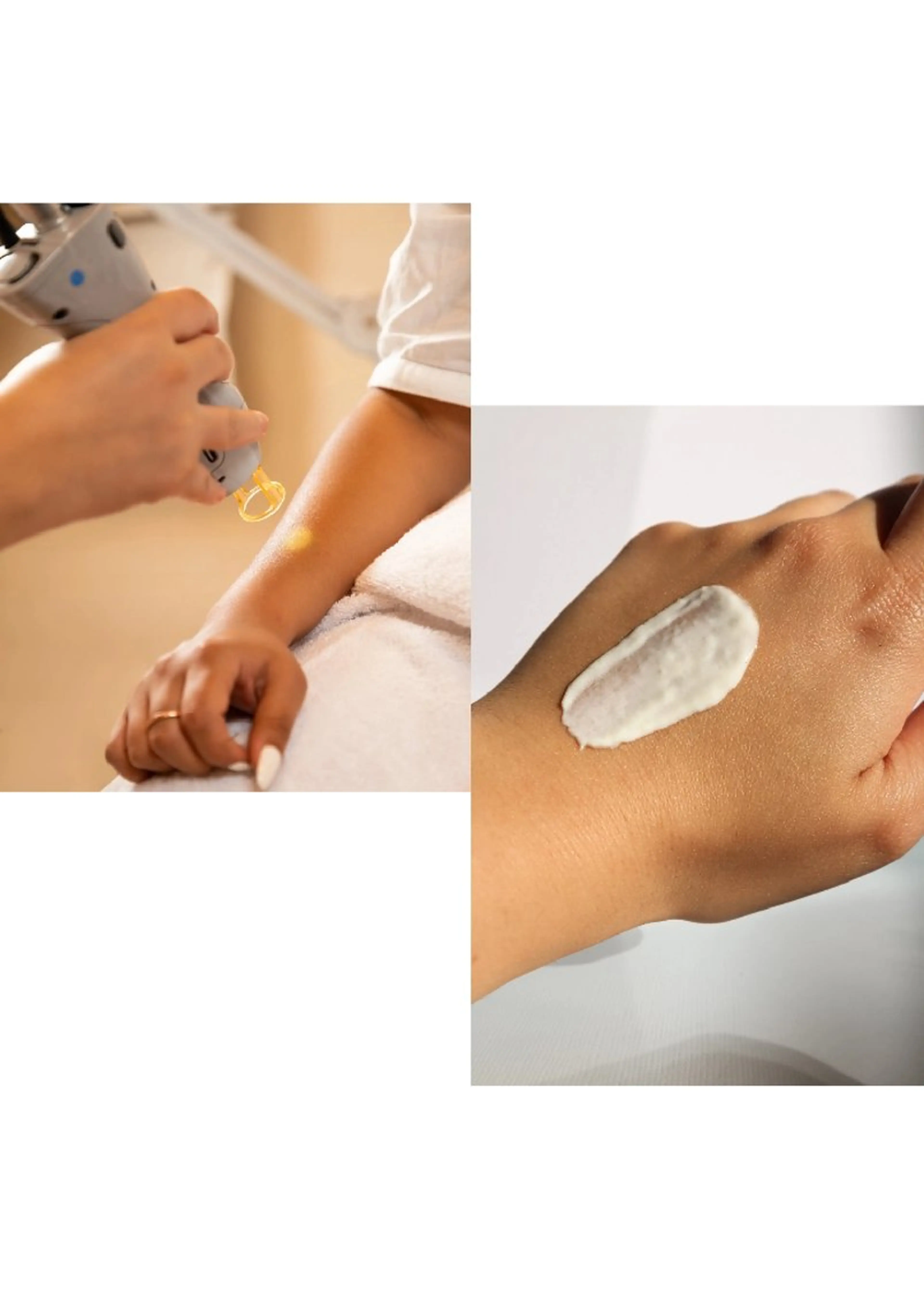 minimo限定⭐ピーリング+脱毛SET両手の甲✋：同時施術で相乗効果♪見えるところの集中ケアセット👶の写真