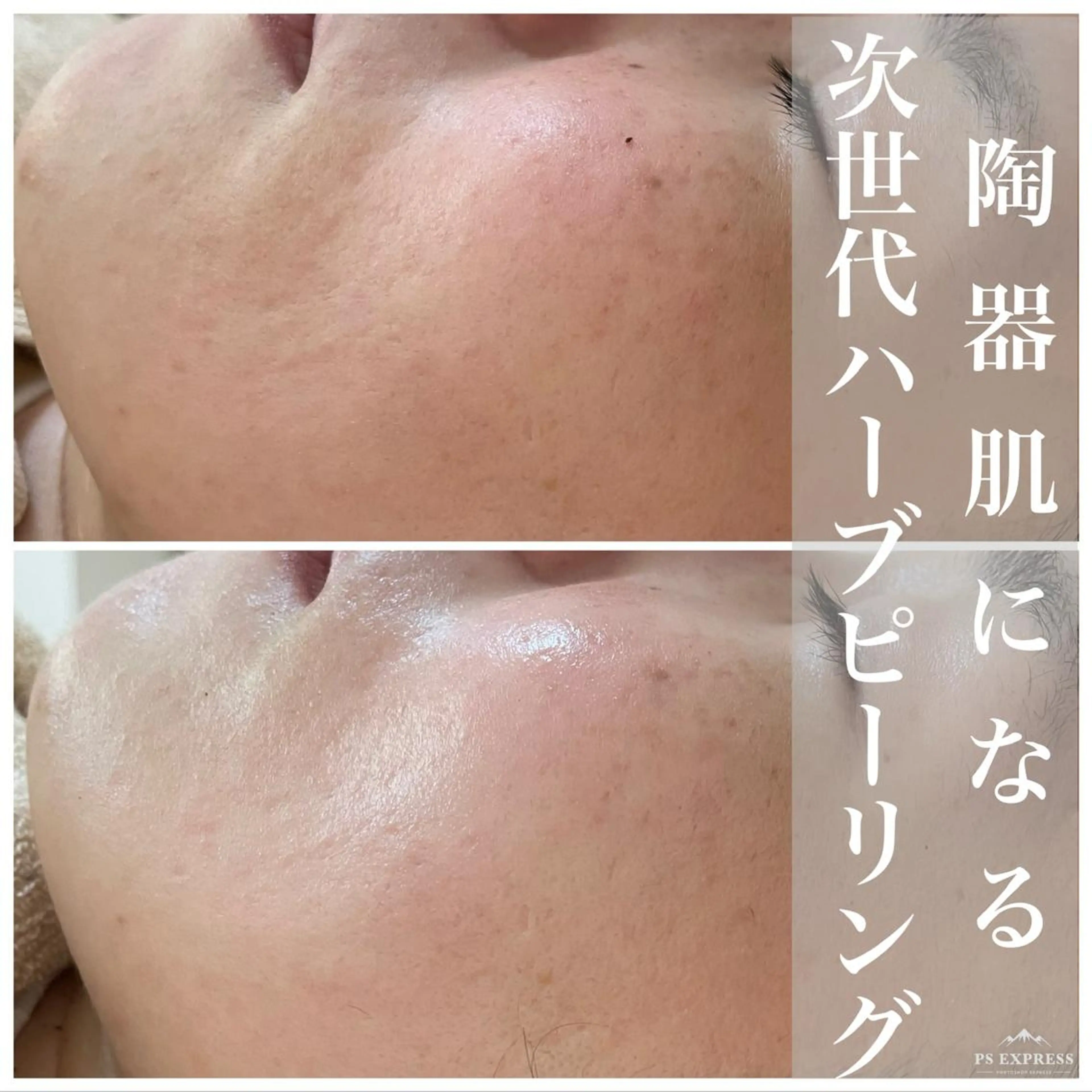 ネイル マツエク・マツパ アイブロウ 卒業式 エステ ニキビ・毛穴改善 🌿ハーブピーリングのエステ・リラクイメージ