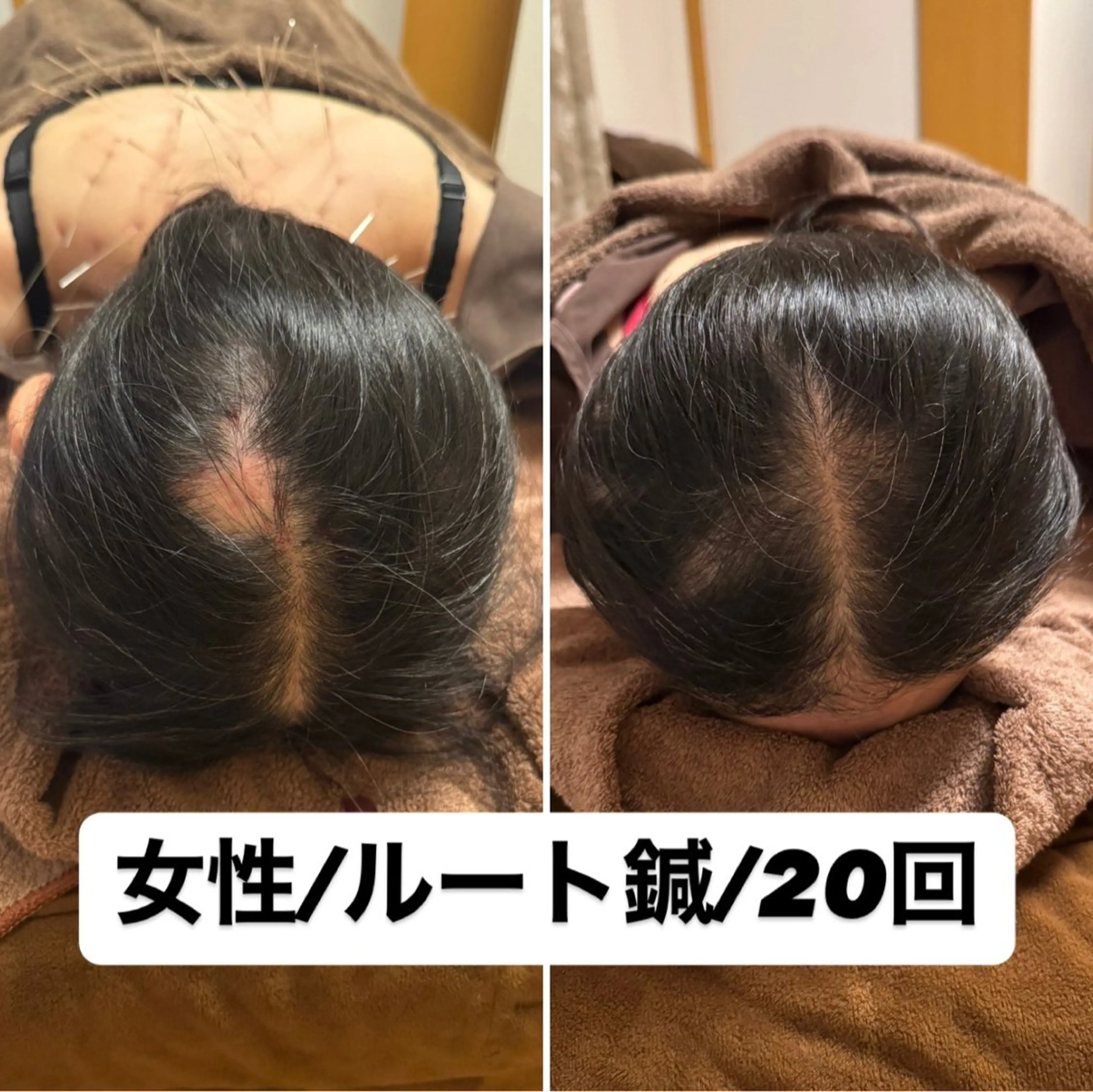 エステ 即小顔♥️美容鍼× ハーブピーリングのその他イメージ