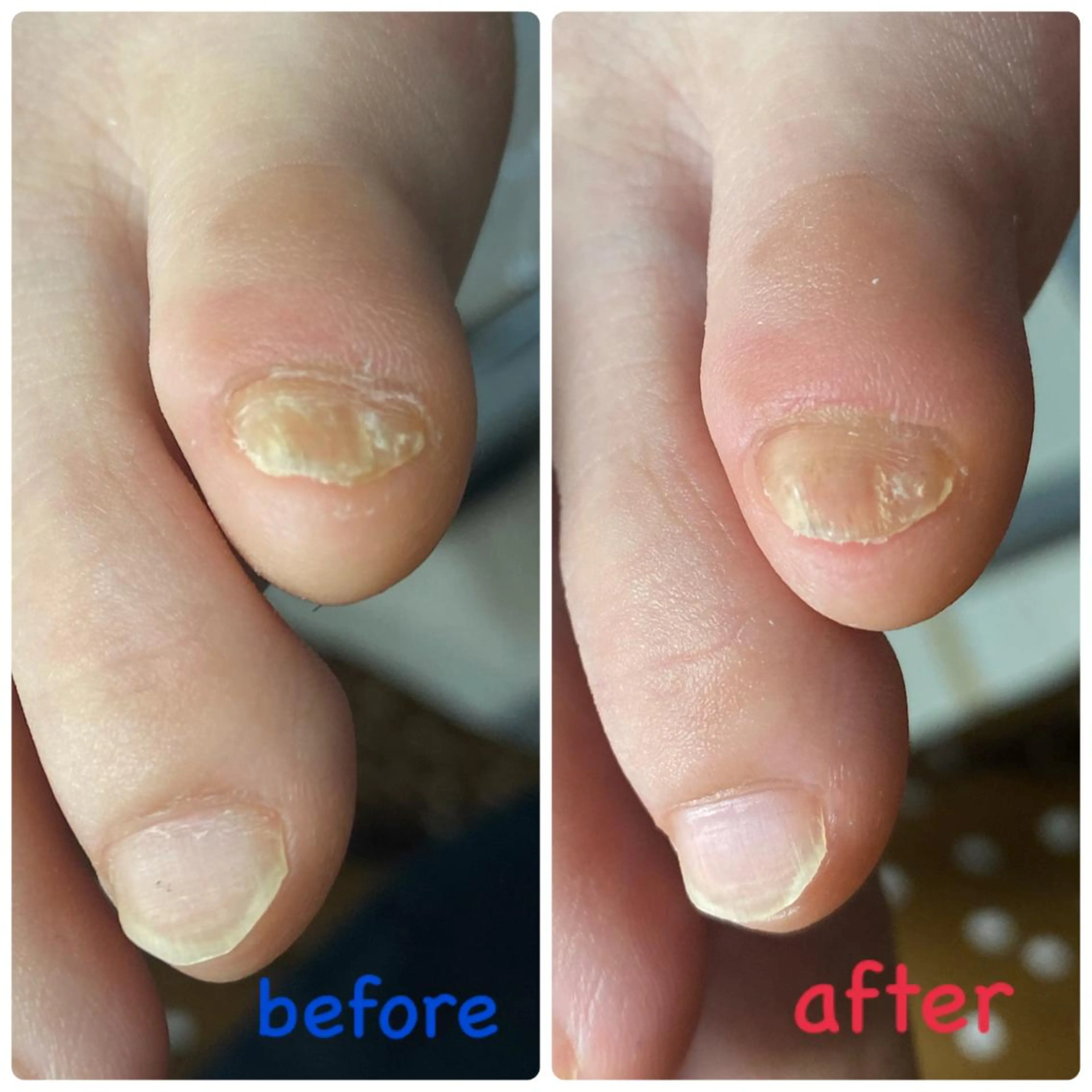 フット②爪切り&お爪周りのケア(フットバス付き)の写真