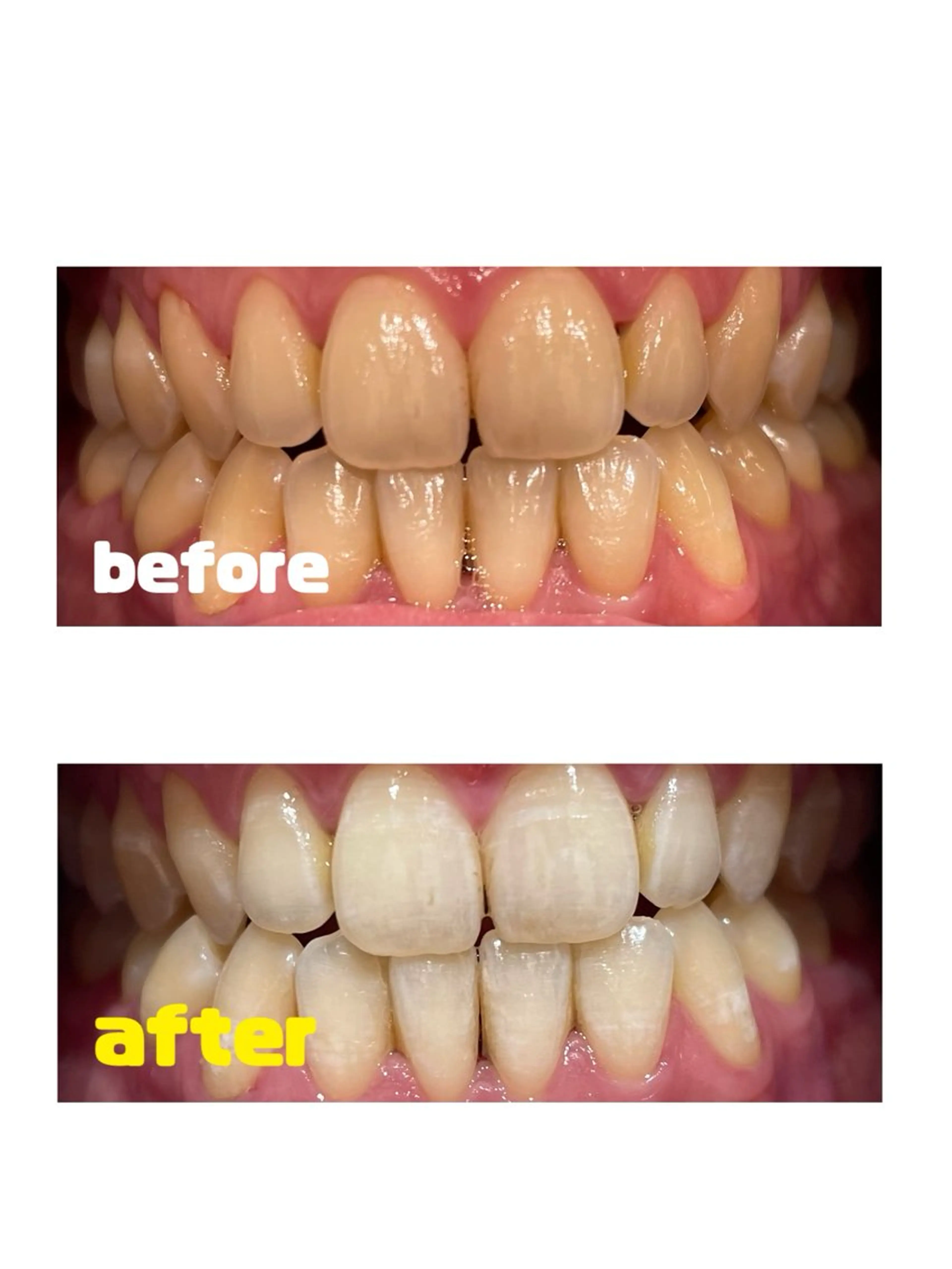 【ミニモ限定】セルフホワイトニング 集中3ヶ月コースの写真