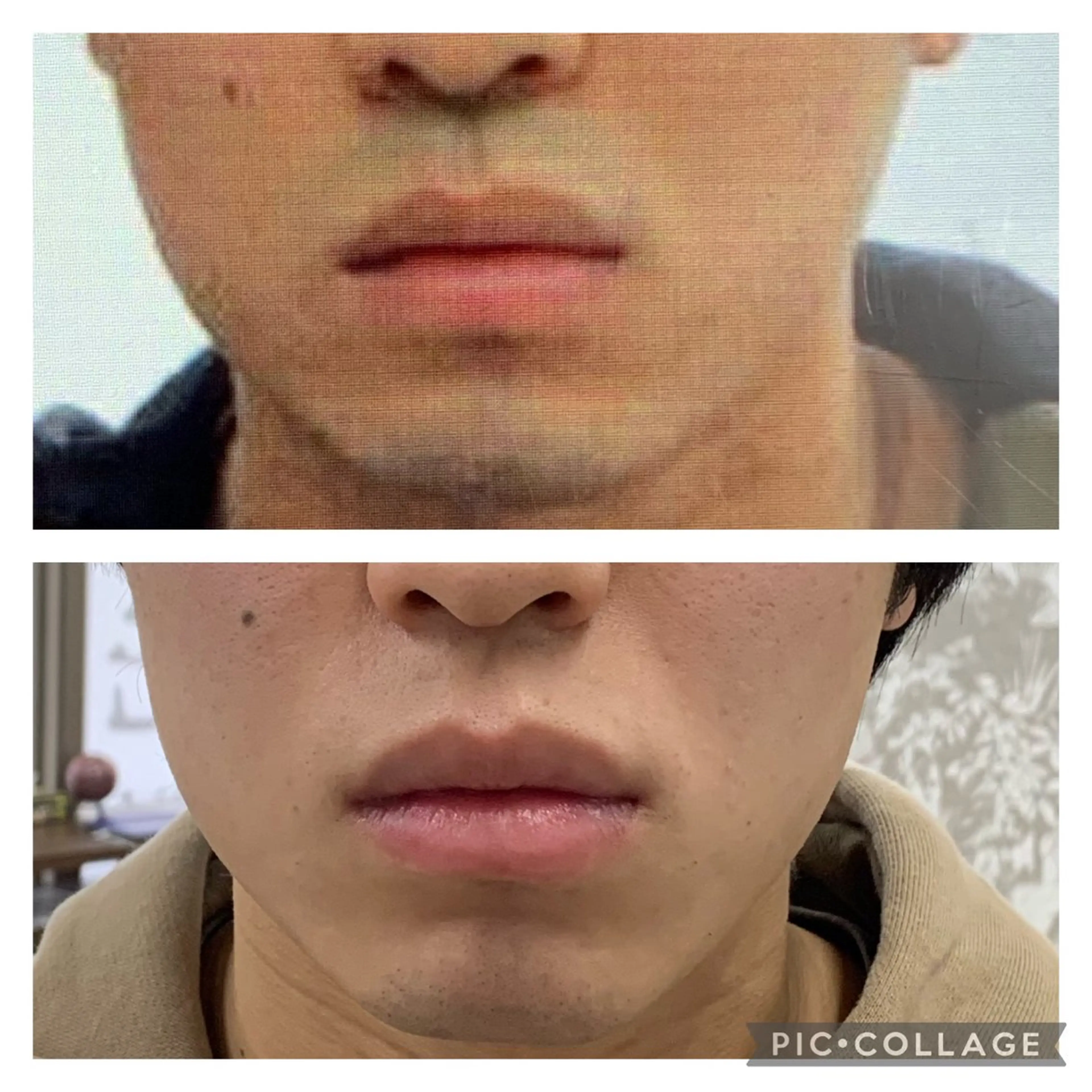 ミニモ学割★今なら2回×20分1000円【メンズ様☆大人気❣️】髭・vioに特化！毎日のめんどうな髭剃りからも卒業ですの写真