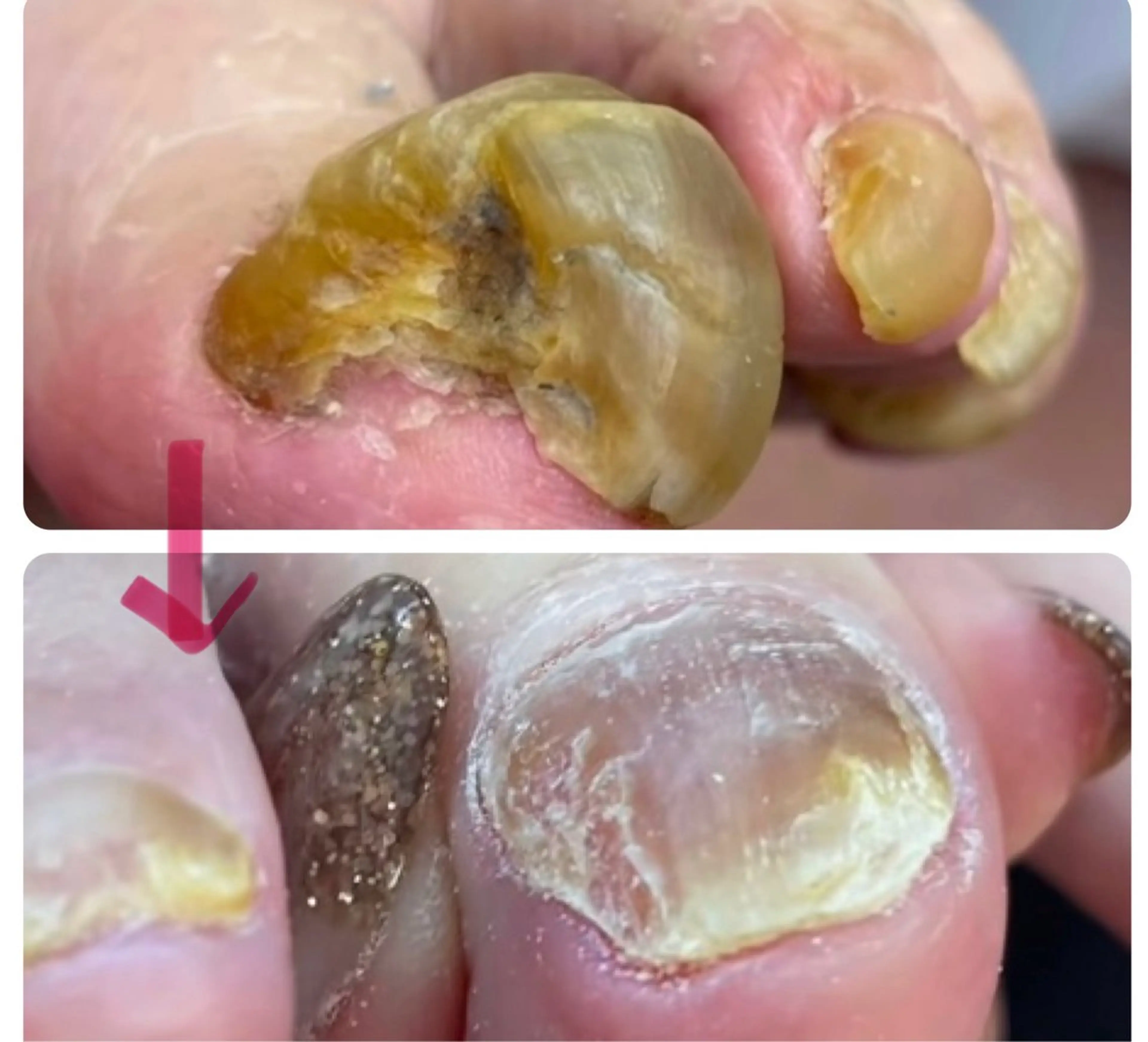 巻き爪、肥厚爪、陥入爪、魚の目ケア、タコケア爪トラブルご相談受けます🙆の写真