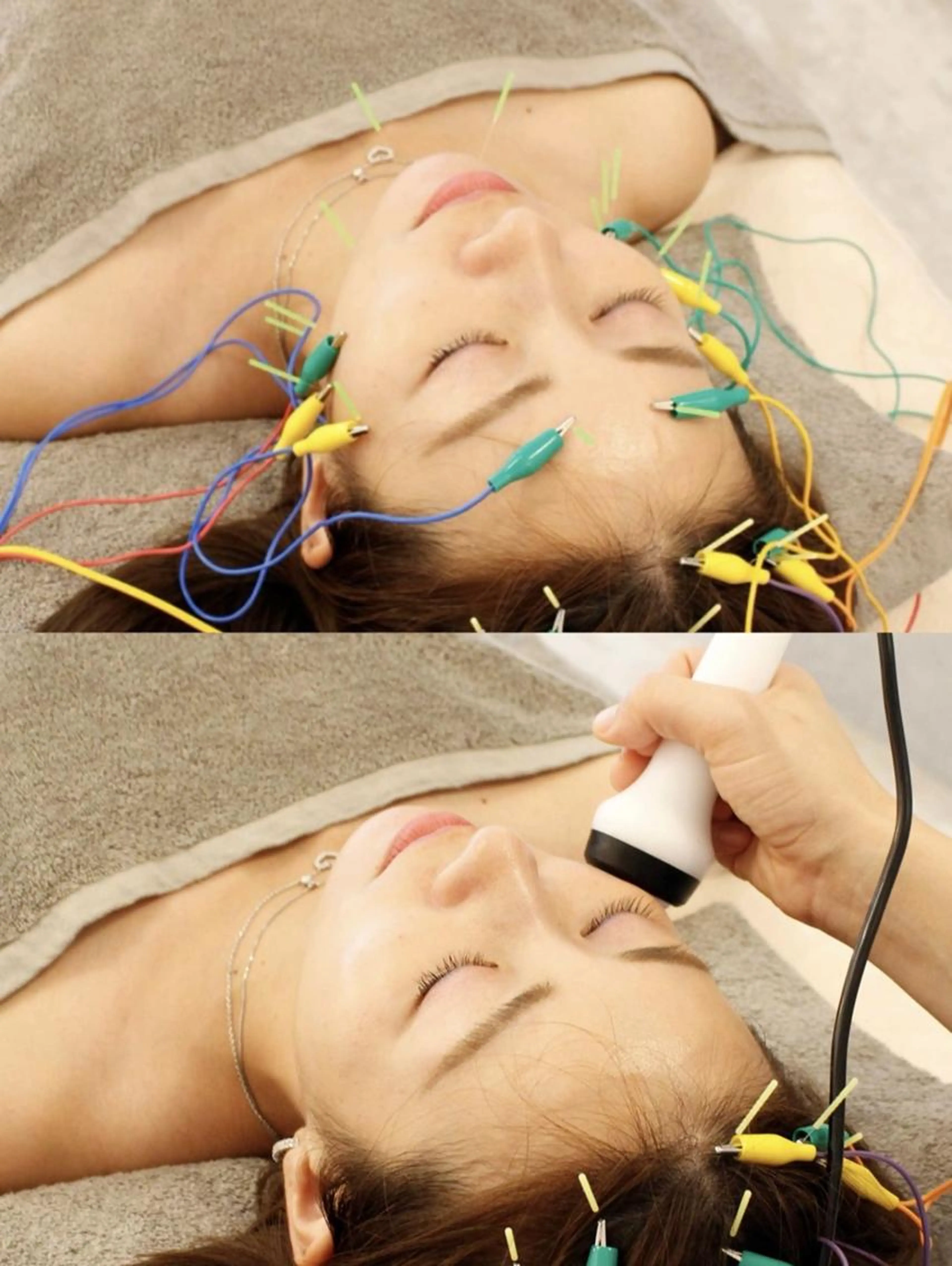 人気No3【即小顔】💥美容鍼＋強力EMS💥フェイスライン激変✨vライン美人/任せてむくみスッキリの写真