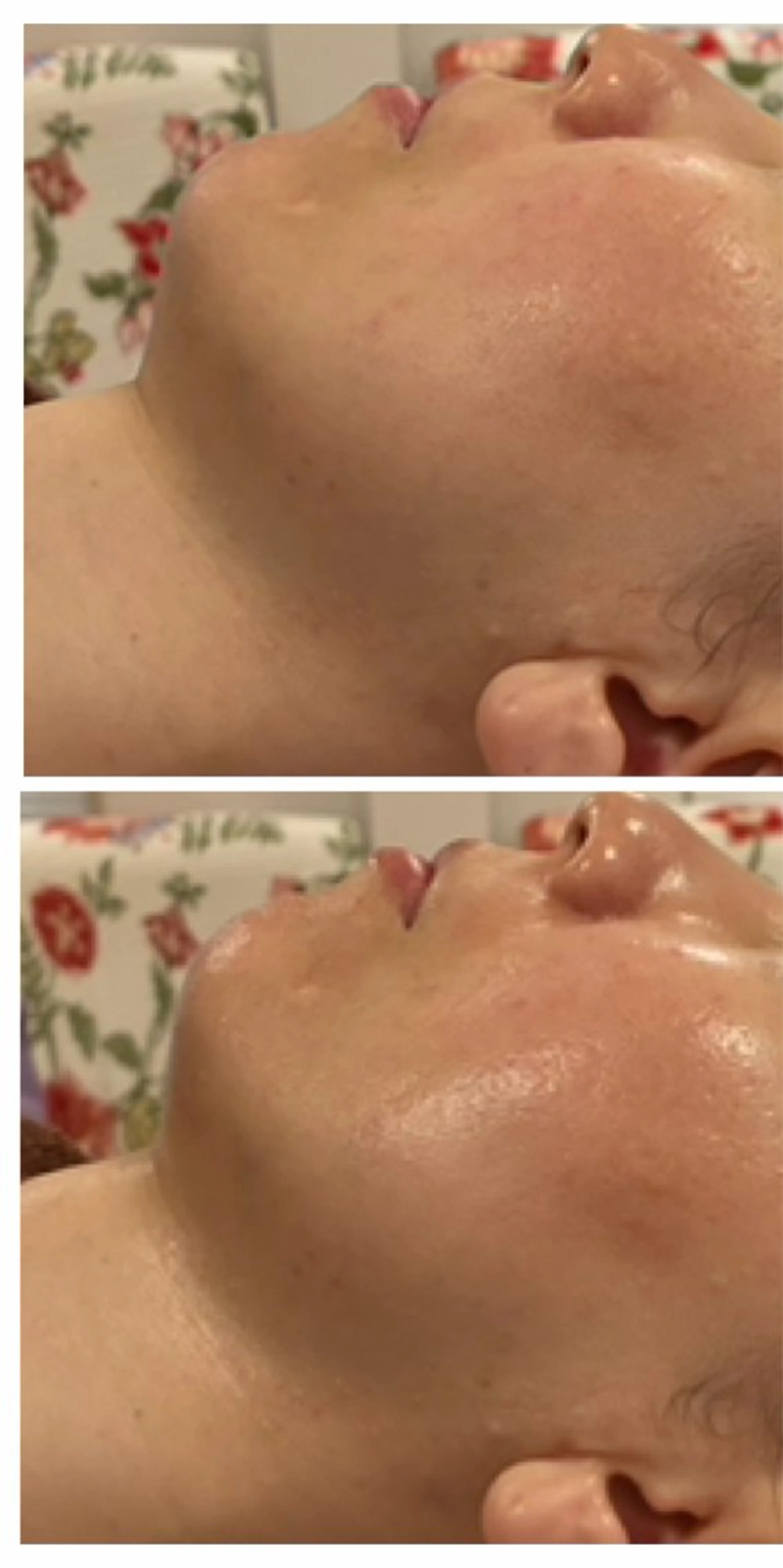 【京都伏見/肌再生】希少サーモンDNA(PDRN)導入✨ソフトダーマペンで本気の肌質改善。月2名様限定の特別ハリ艶コースの写真