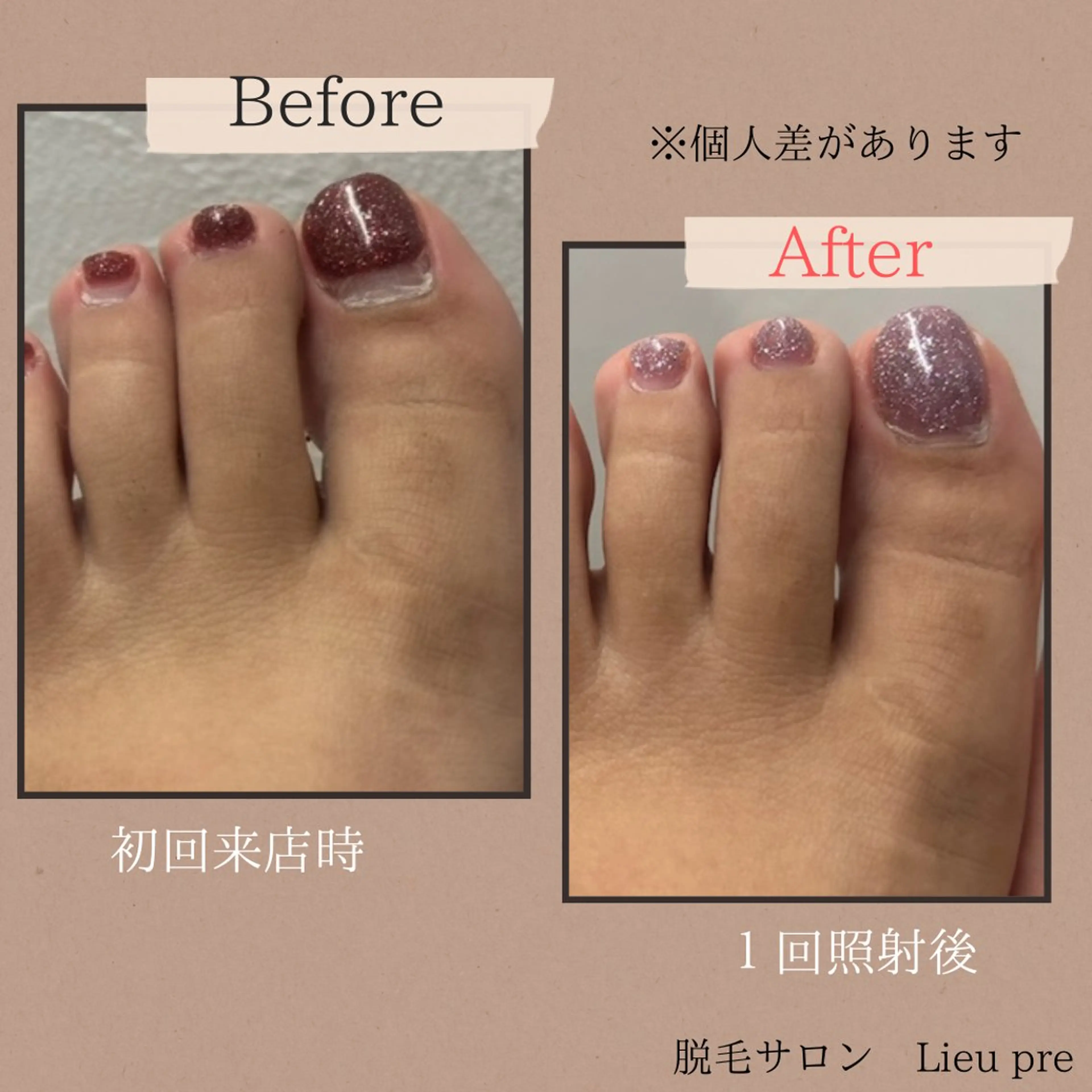 lieupré 脱毛 oshima‎⌣̈のエステ・リラクイメージ