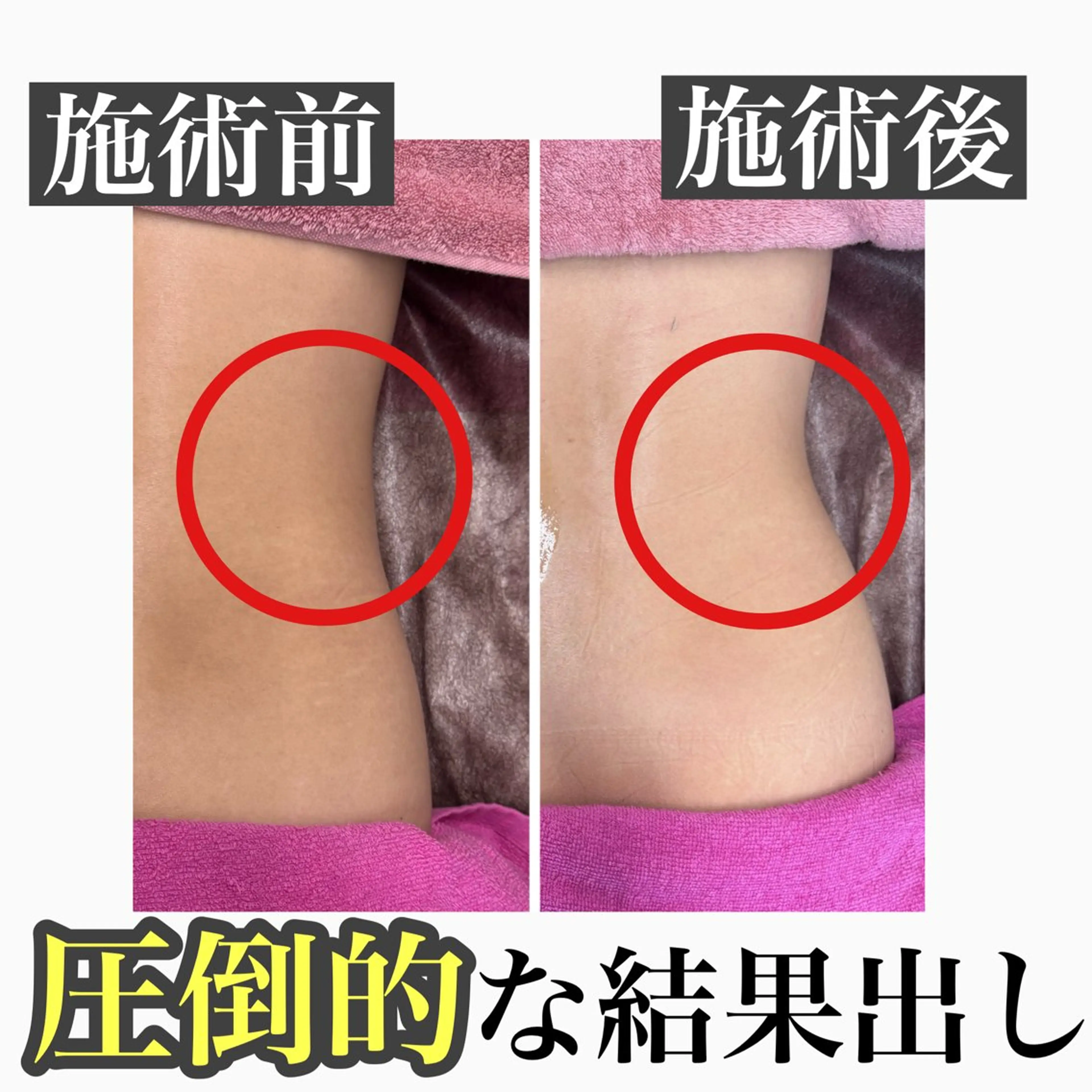 【次世代の痩身❤️‍🔥】業界最高濃度溶解剤10ml ×ラジオ波の写真