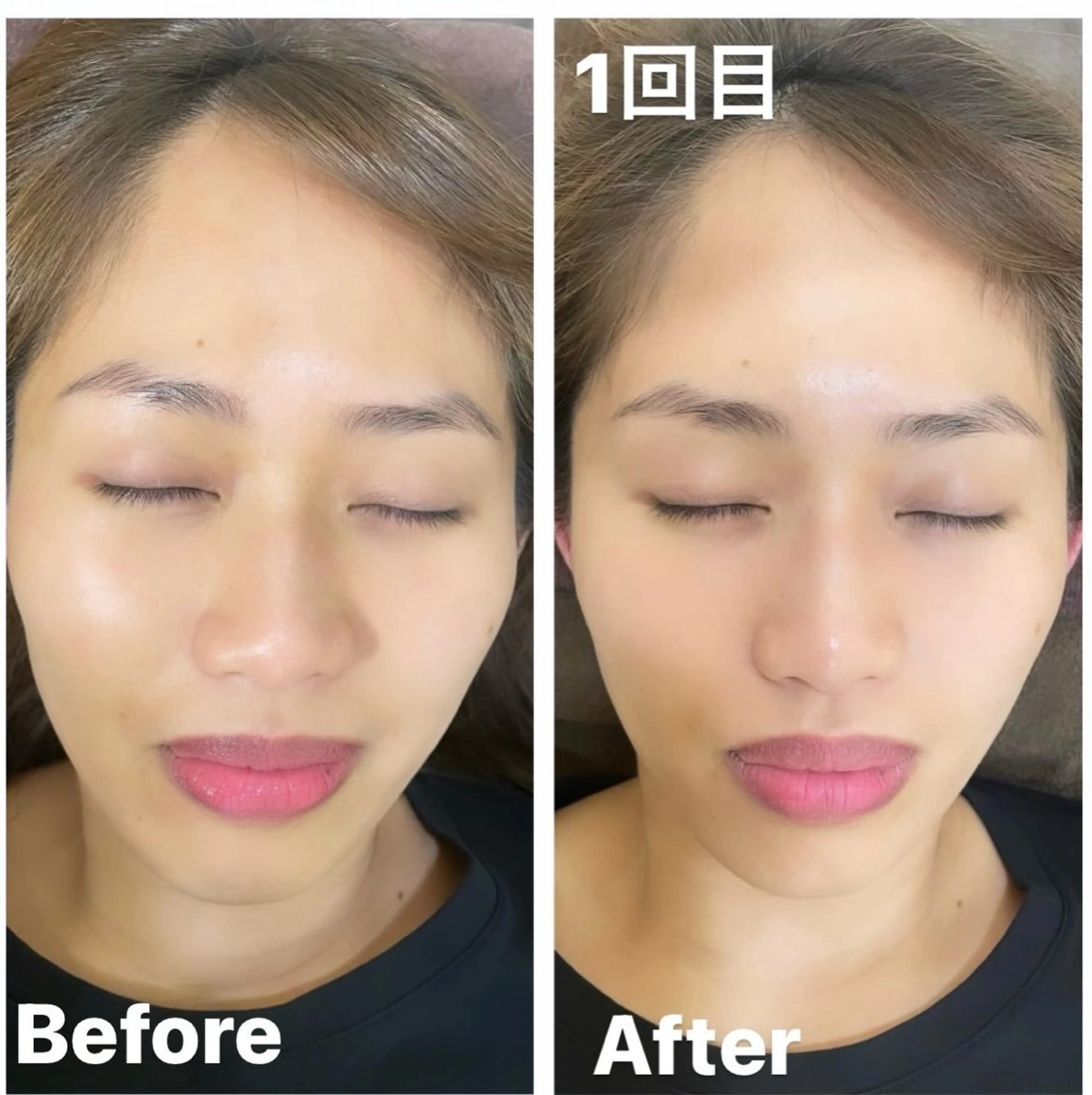 小顔矯正💆♀️💎ブライダルにも♡の写真